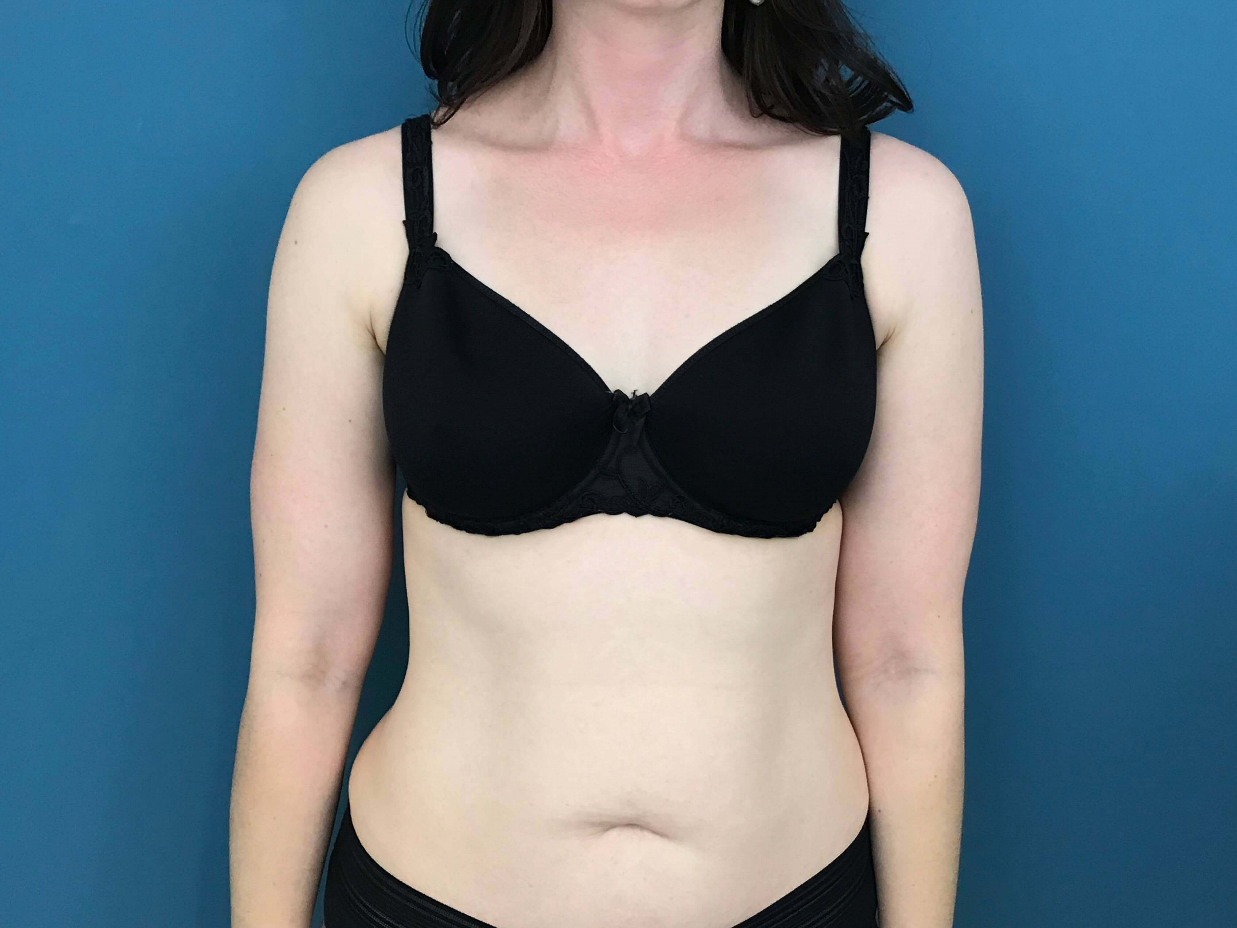Bilateral Brachioplasty (Arm Lift) and Arm Liposuction — before, view 2