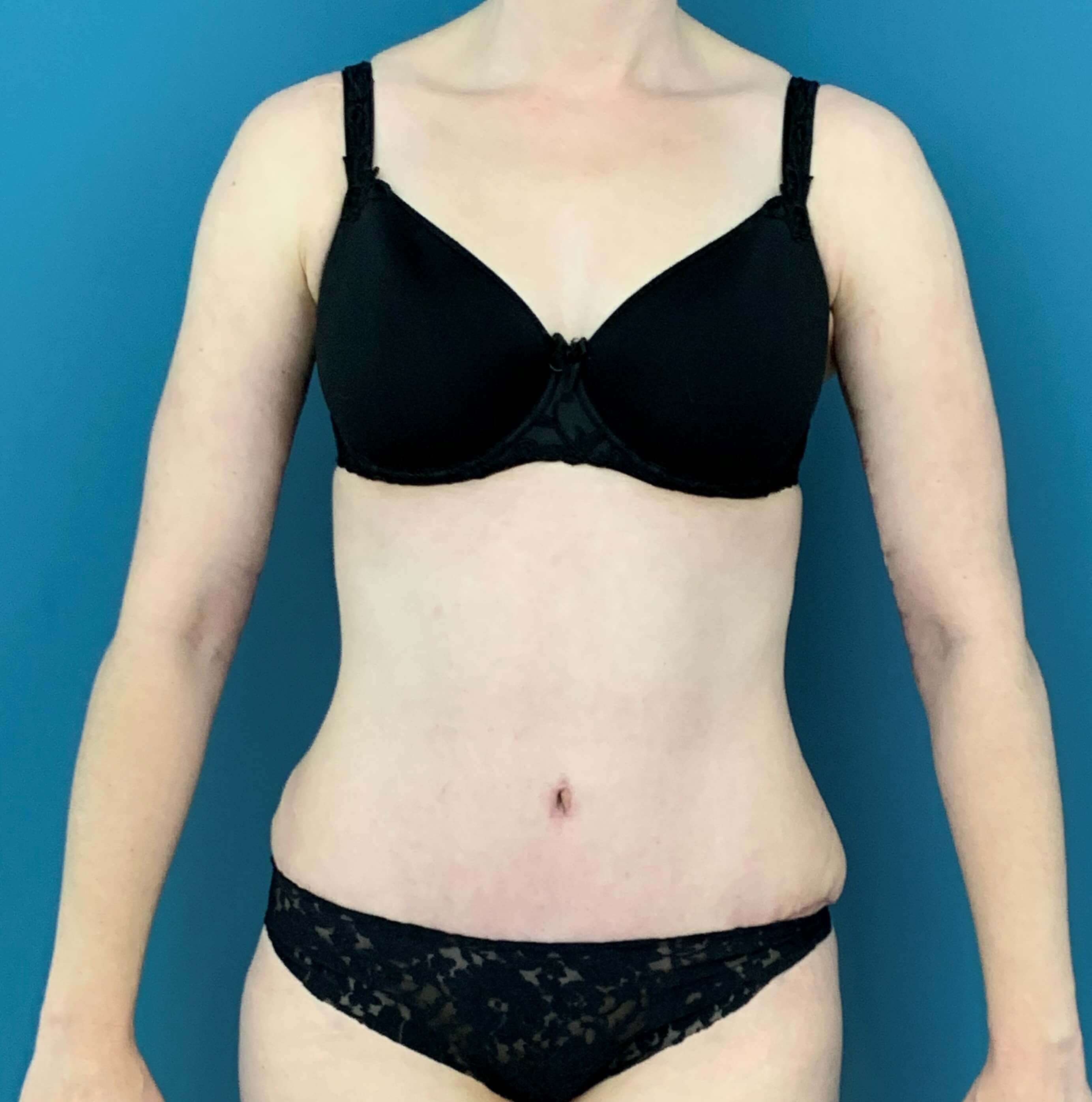 Bilateral Brachioplasty (Arm Lift) and Arm Liposuction — after, view 2