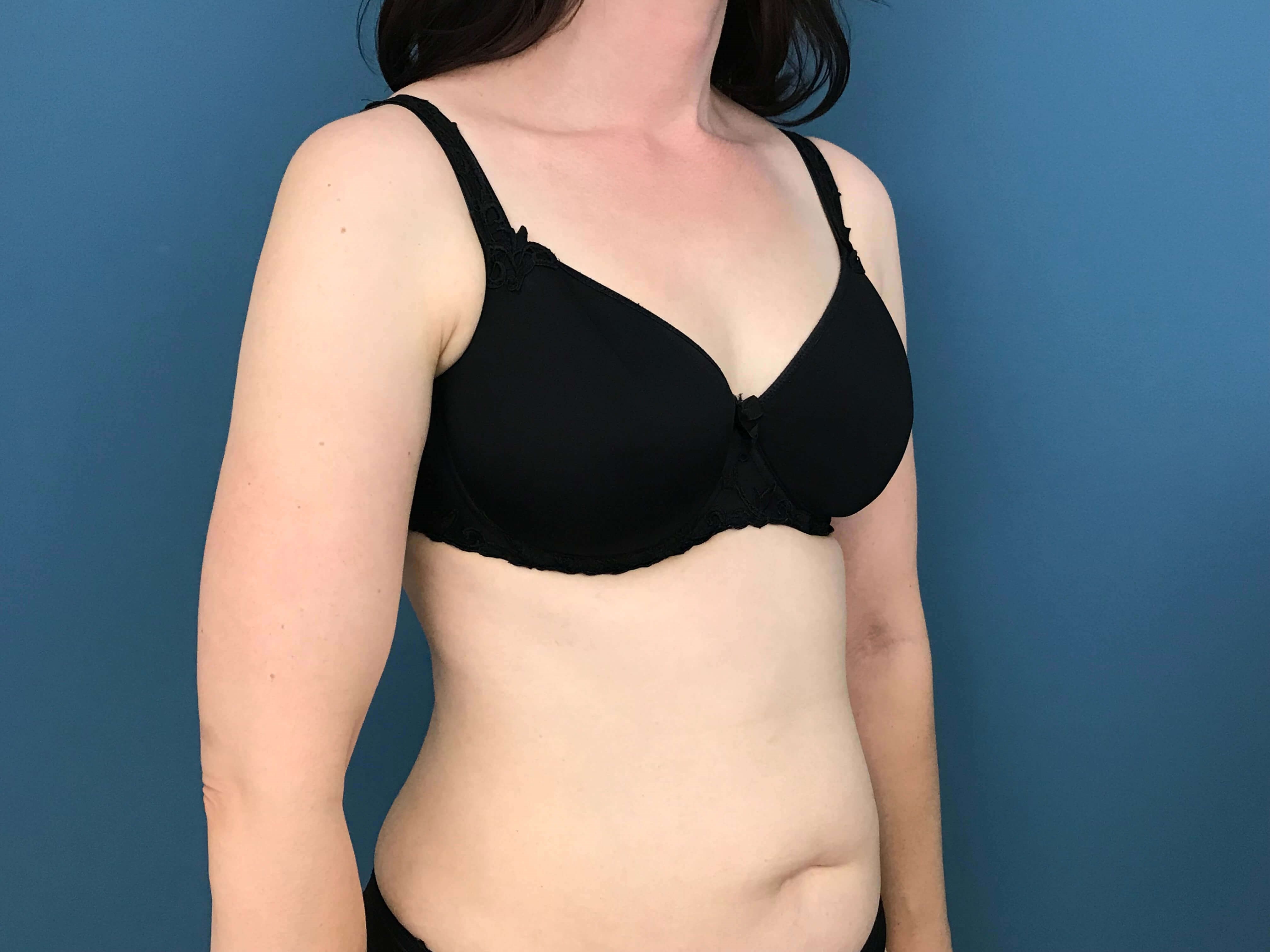Bilateral Brachioplasty (Arm Lift) and Arm Liposuction — before, view 3