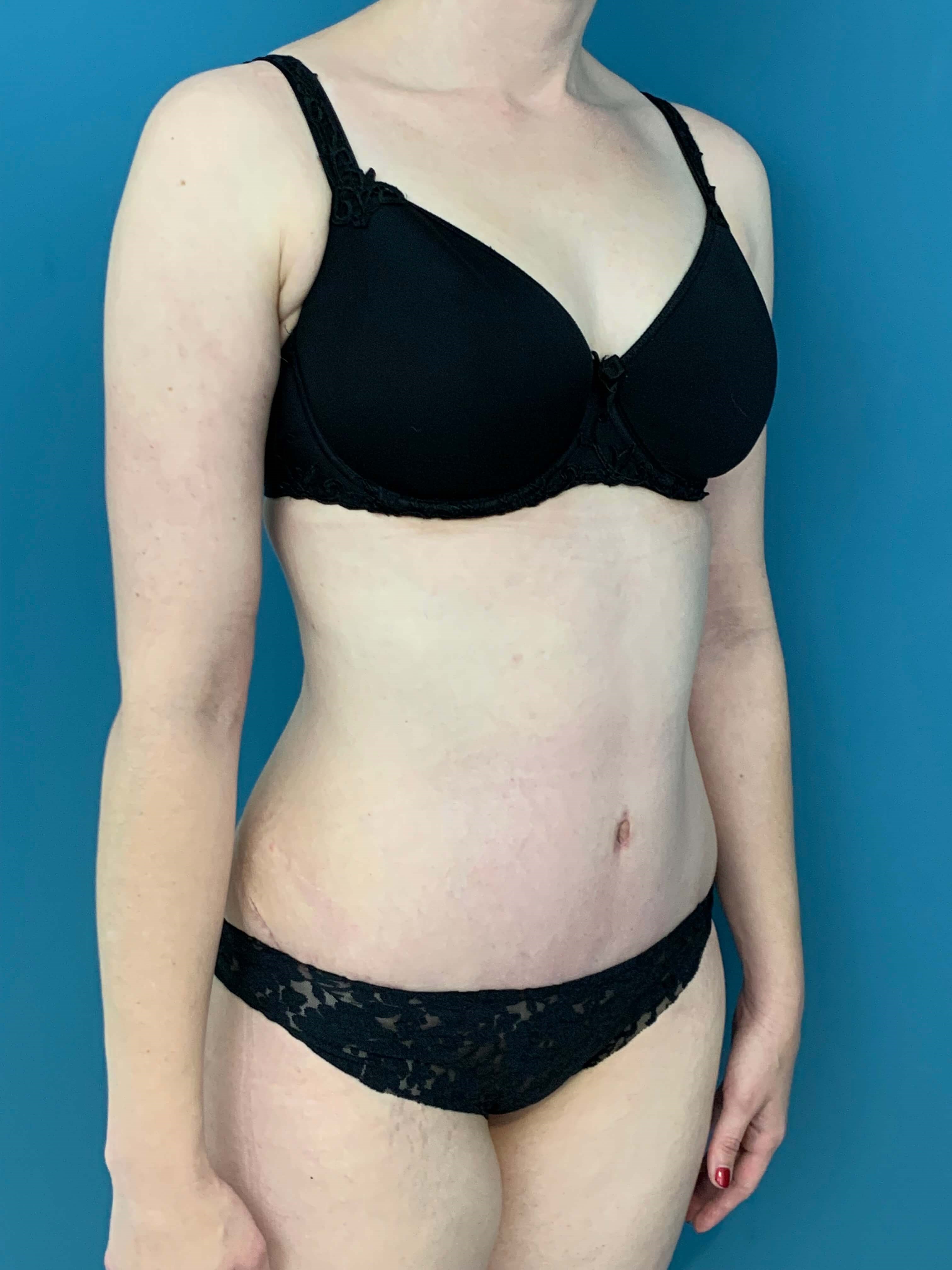 Bilateral Brachioplasty (Arm Lift) and Arm Liposuction — after, view 3