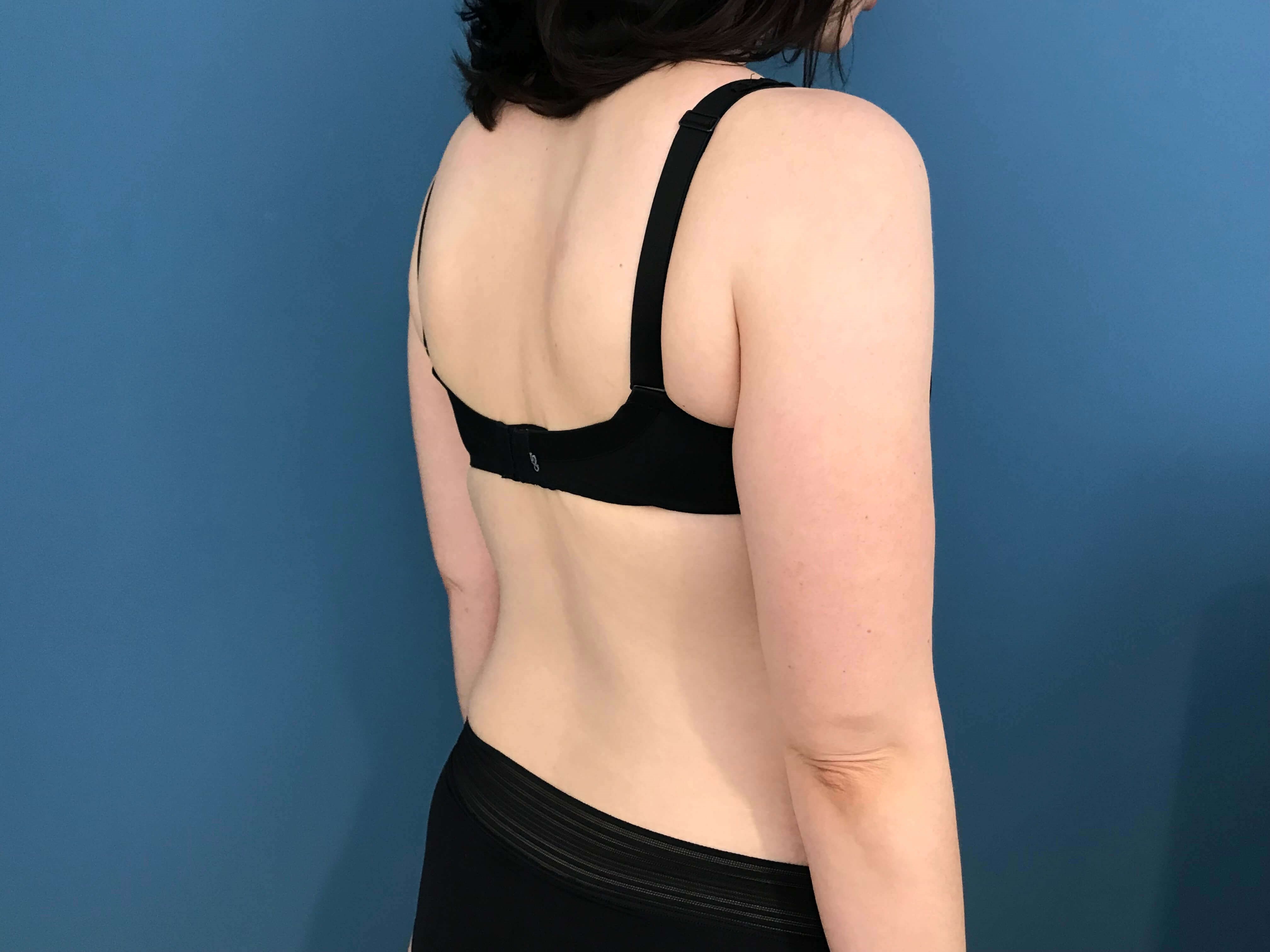 Bilateral Brachioplasty (Arm Lift) and Arm Liposuction — before, view 4