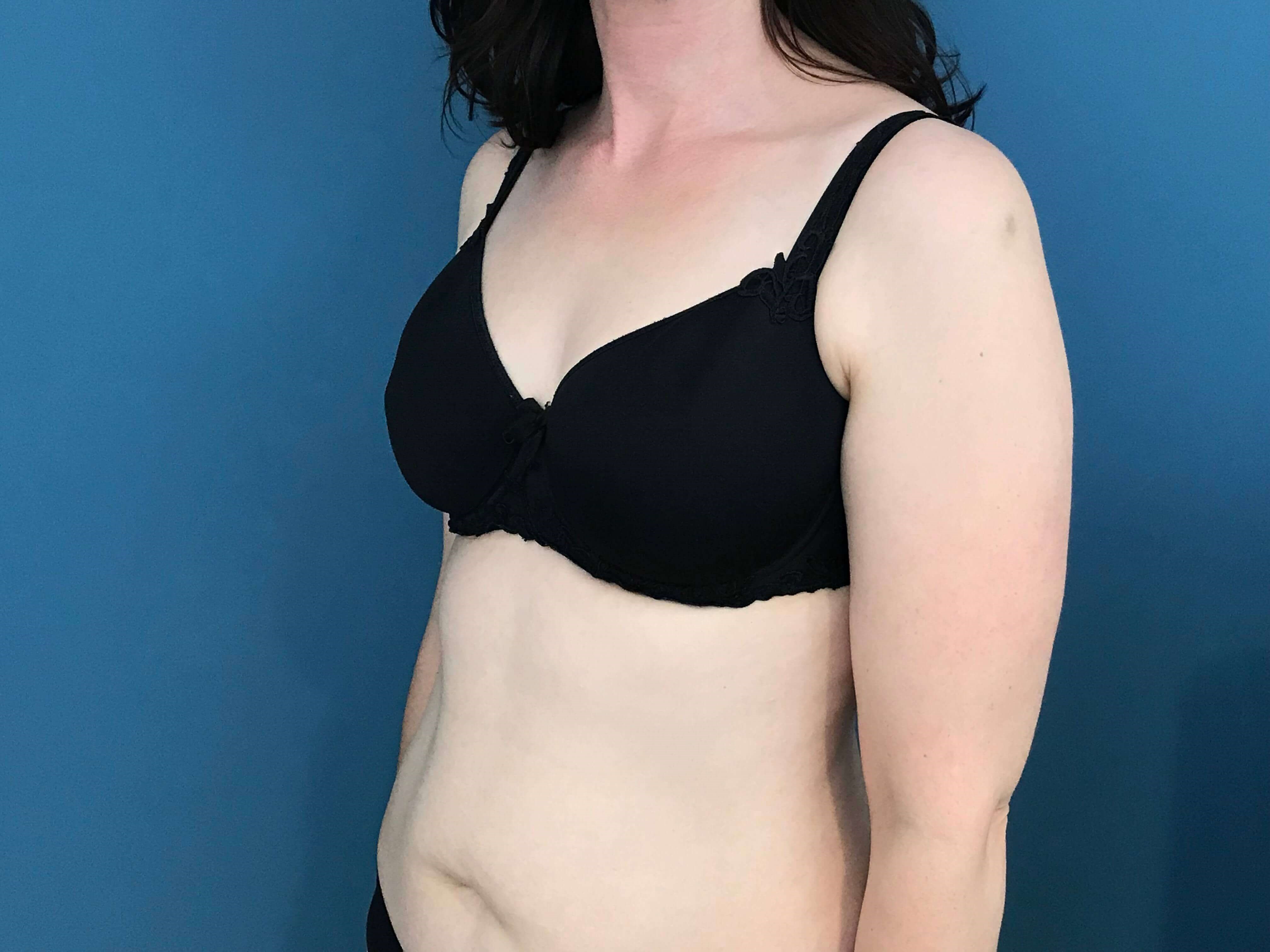 Bilateral Brachioplasty (Arm Lift) and Arm Liposuction — before, view 5