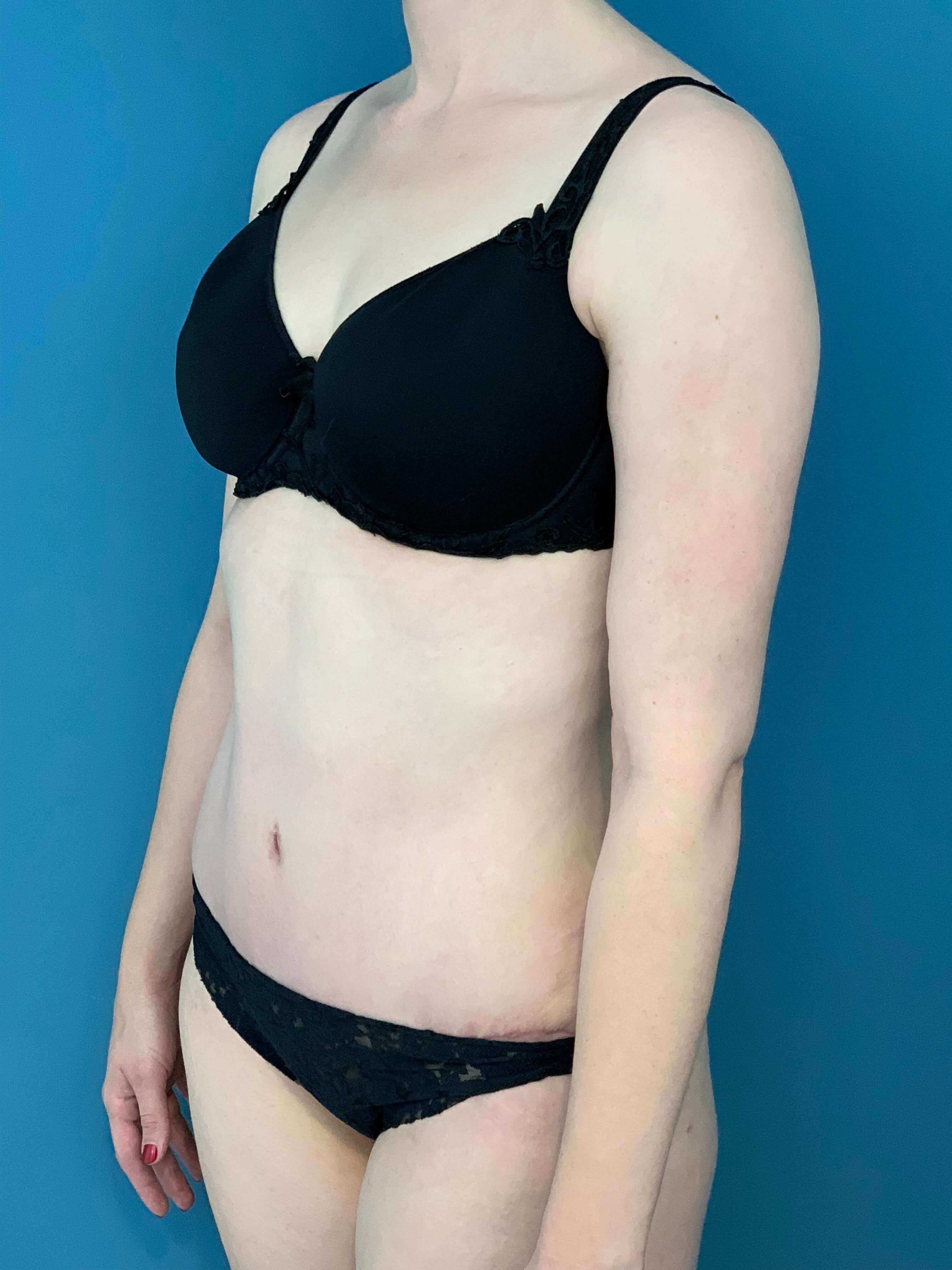 Bilateral Brachioplasty (Arm Lift) and Arm Liposuction — after, view 5