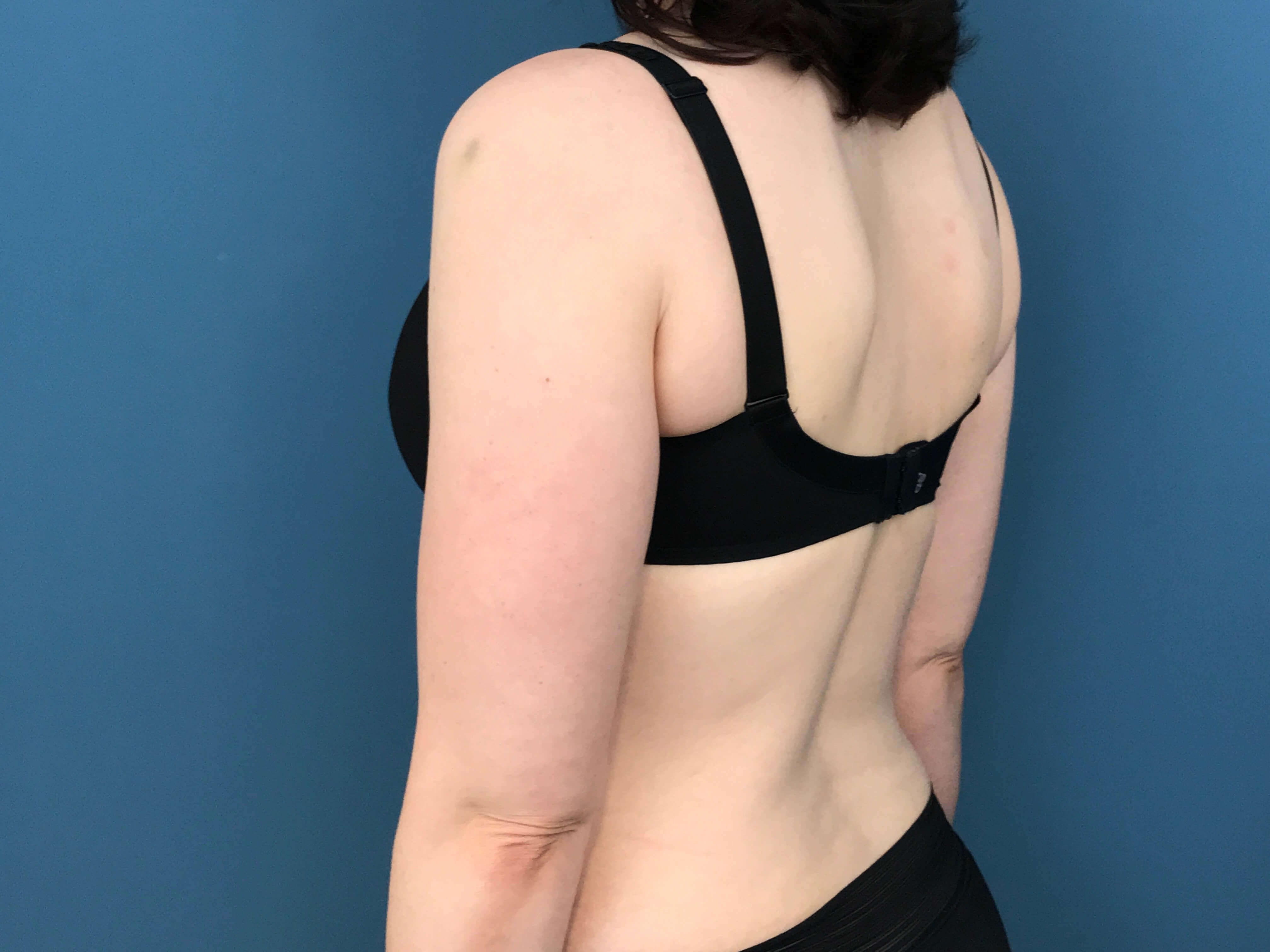 Bilateral Brachioplasty (Arm Lift) and Arm Liposuction — before, view 6