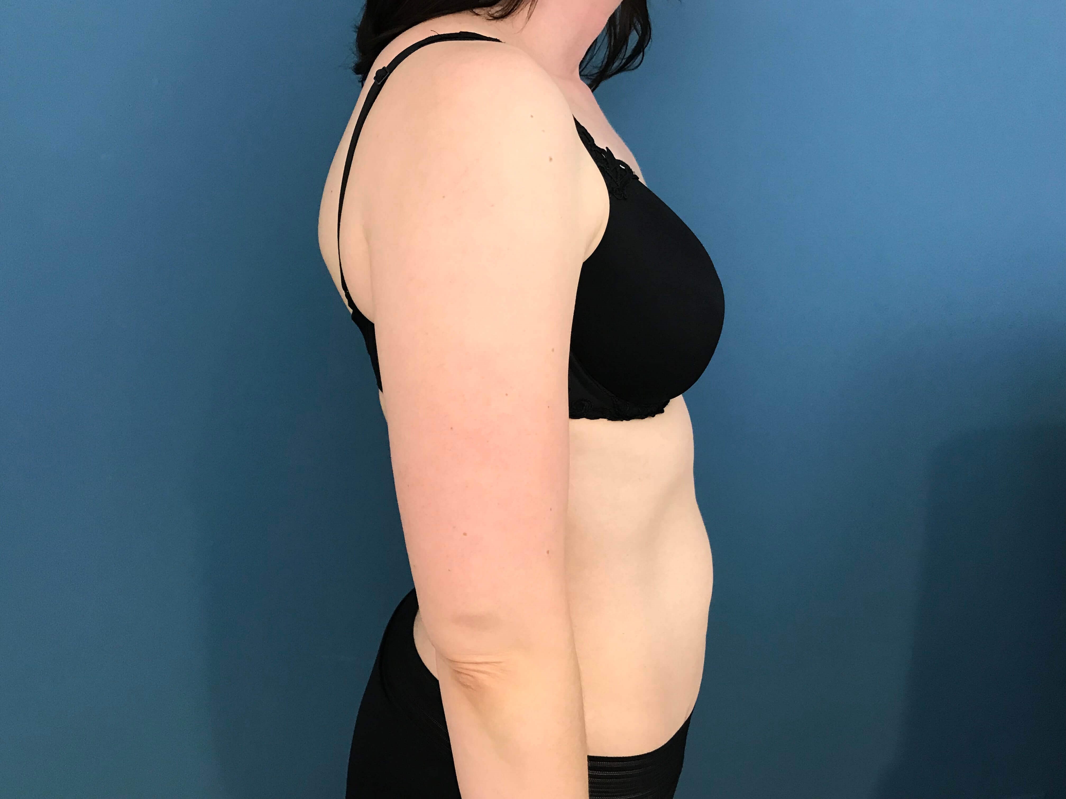 Bilateral Brachioplasty (Arm Lift) and Arm Liposuction — before, view 7