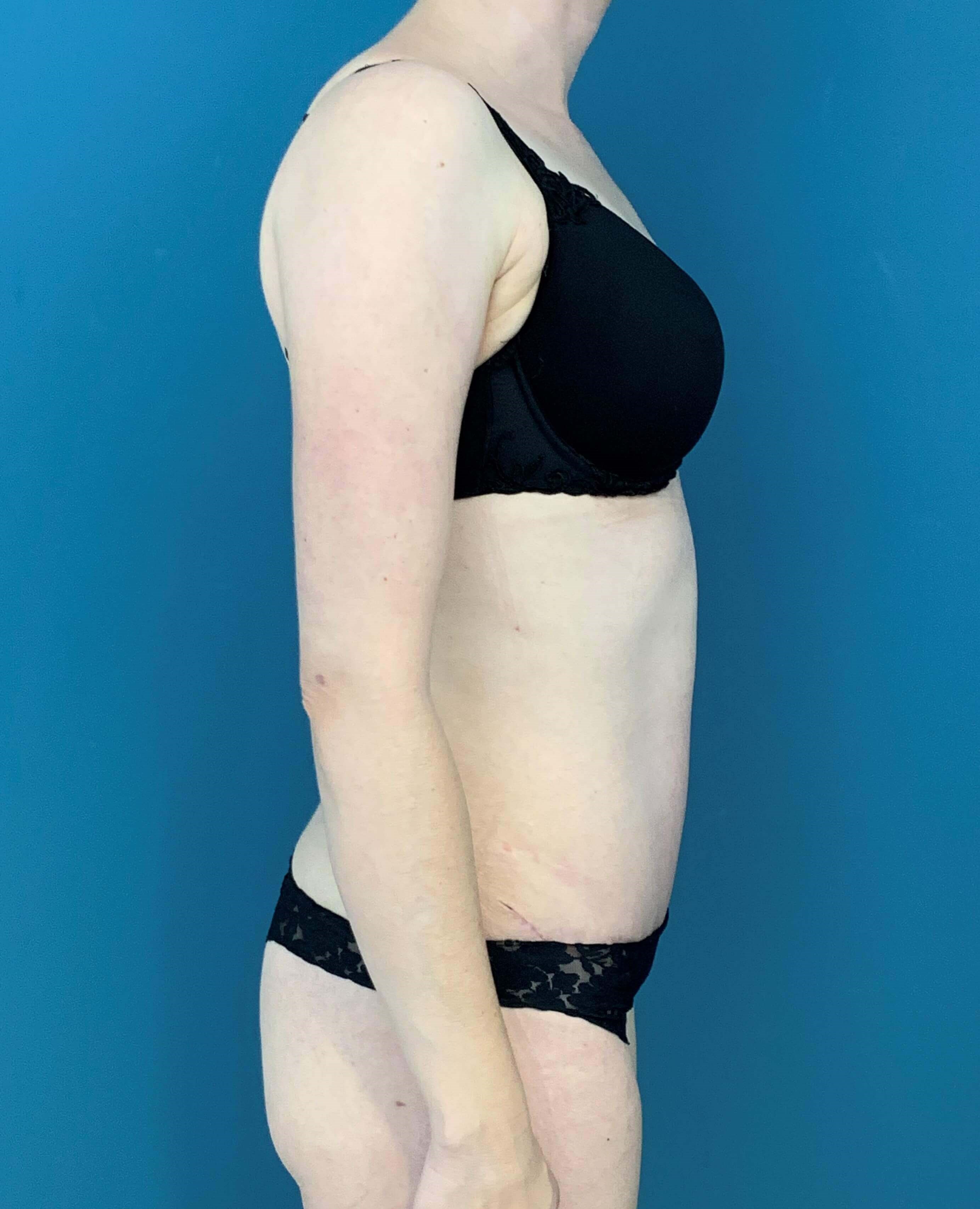 Bilateral Brachioplasty (Arm Lift) and Arm Liposuction — after, view 7