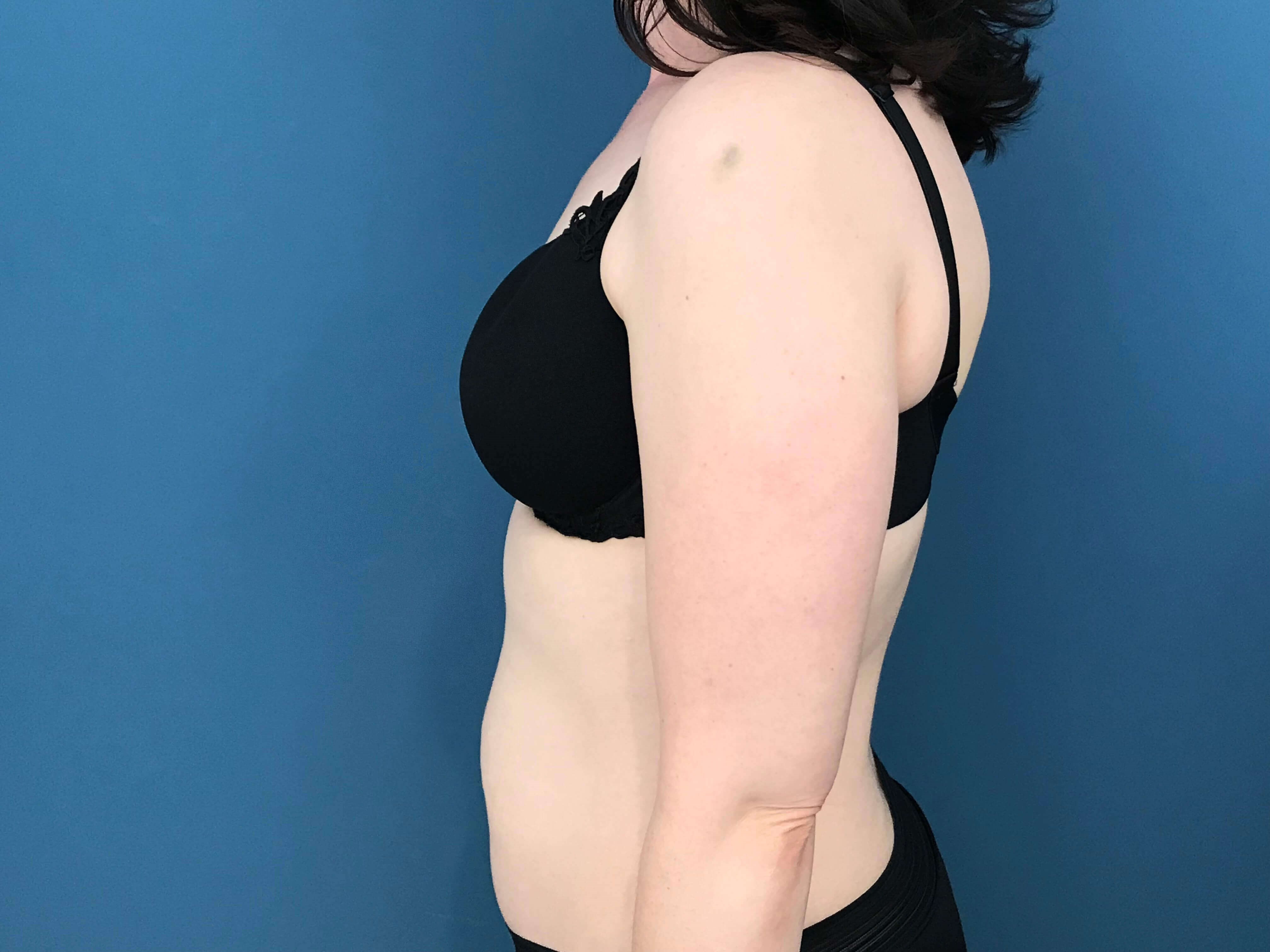 Bilateral Brachioplasty (Arm Lift) and Arm Liposuction — before, view 8
