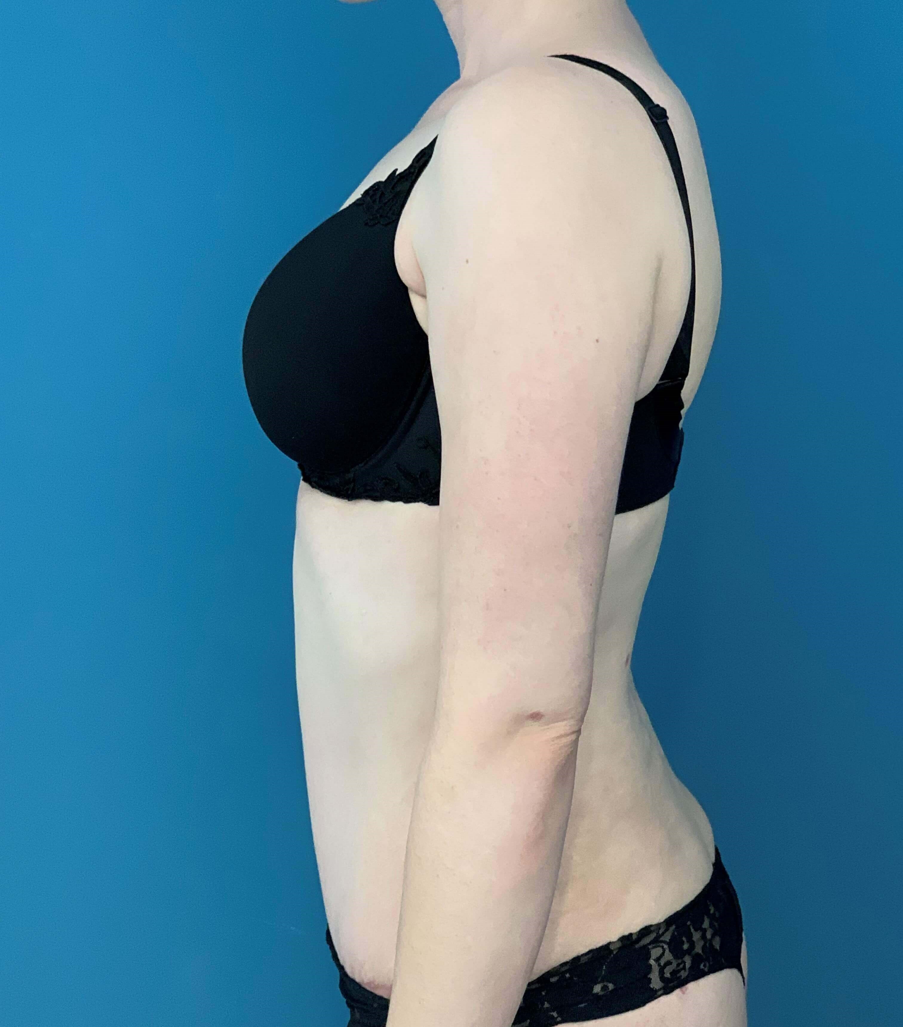 Bilateral Brachioplasty (Arm Lift) and Arm Liposuction — after, view 8