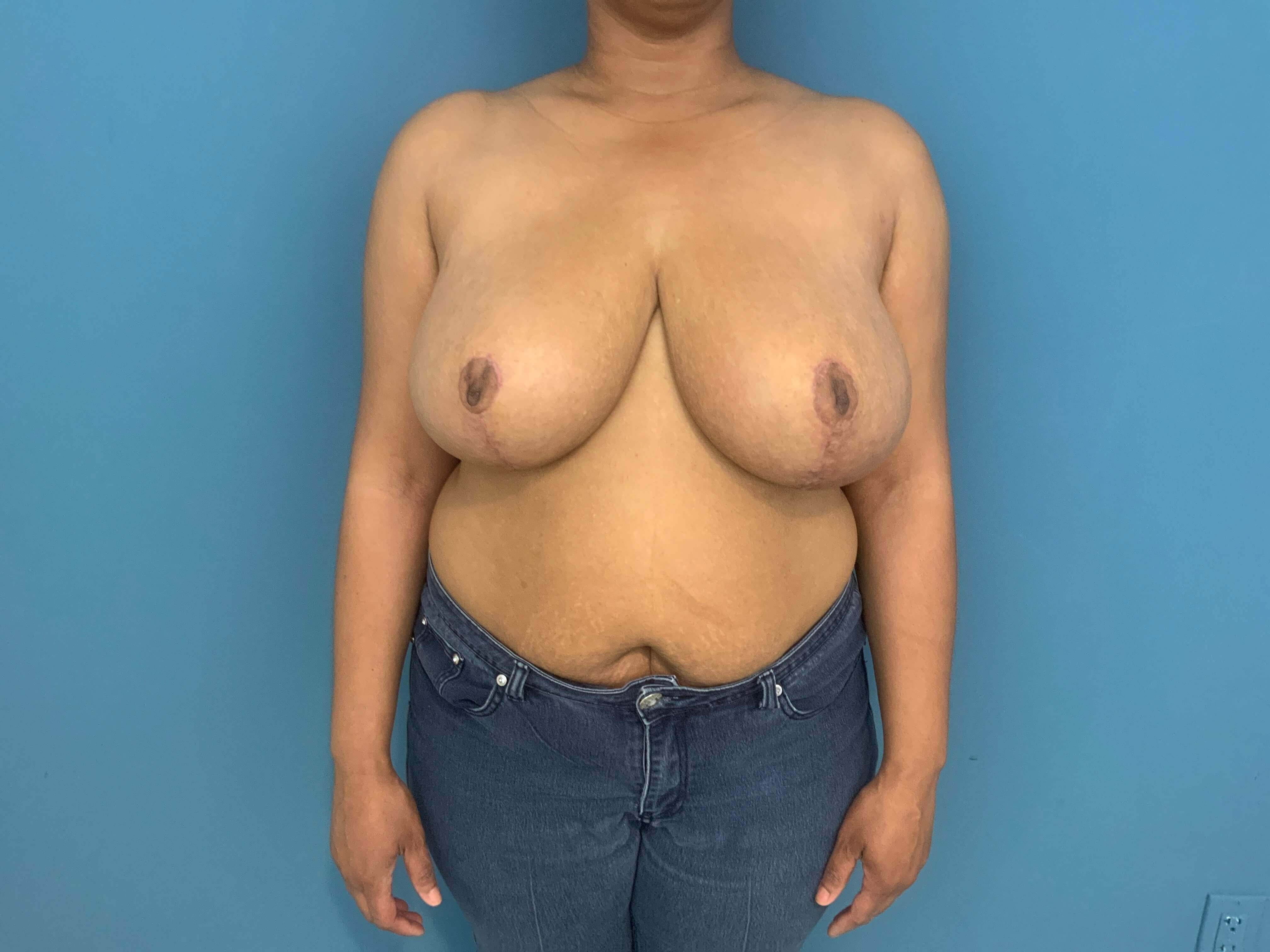 Bilateral Reduction Mammaplasty From H Cup to DD Cup