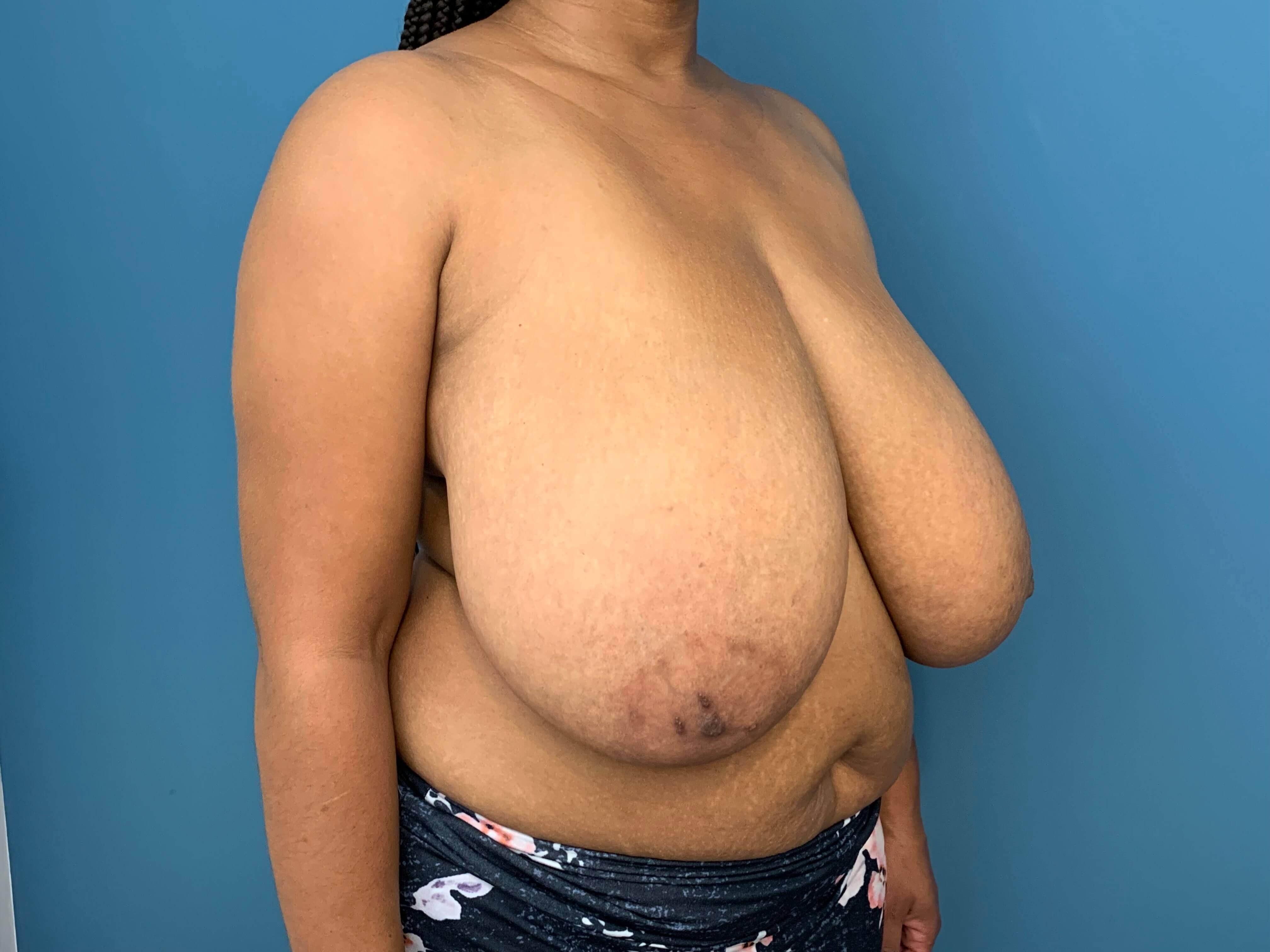 Bilateral Reduction Mammaplasty From H Cup to DD Cup — before, view 2