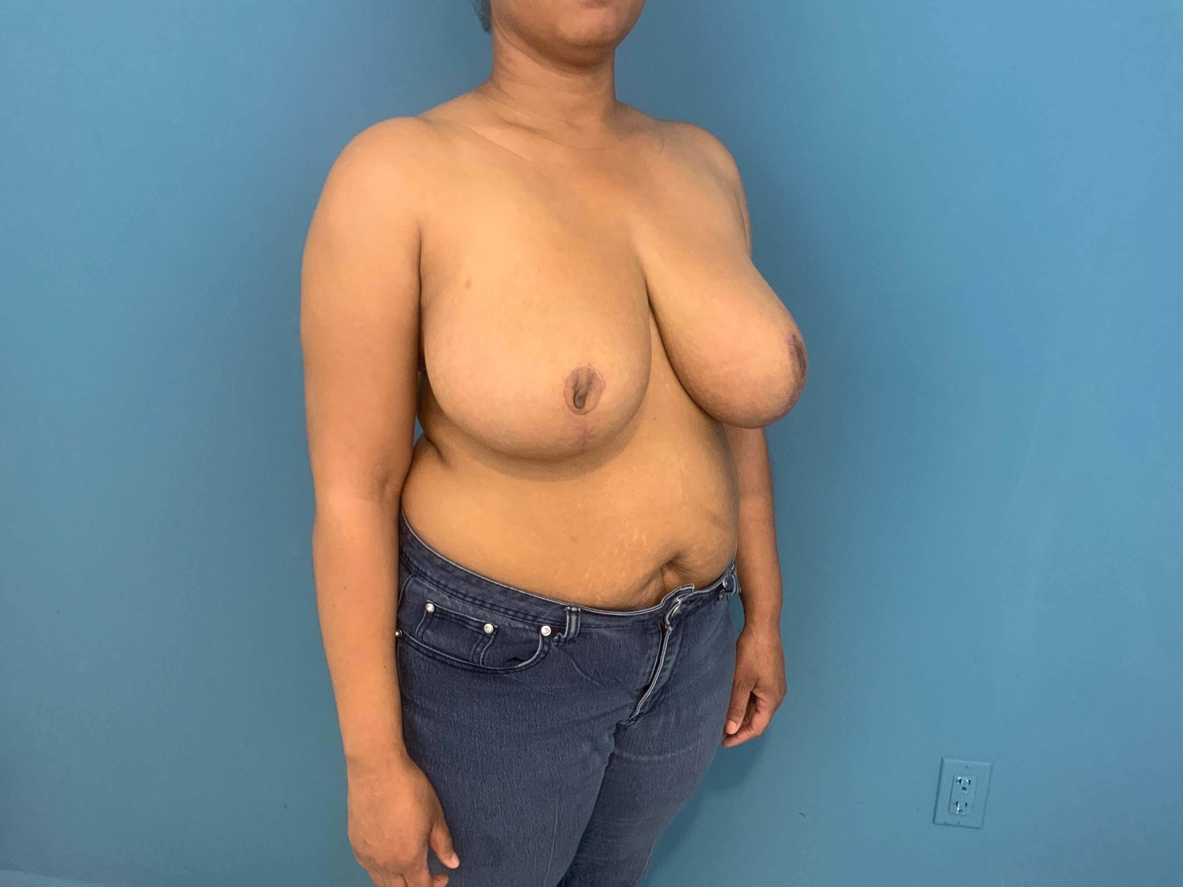 Bilateral Reduction Mammaplasty From H Cup to DD Cup — after, view 2
