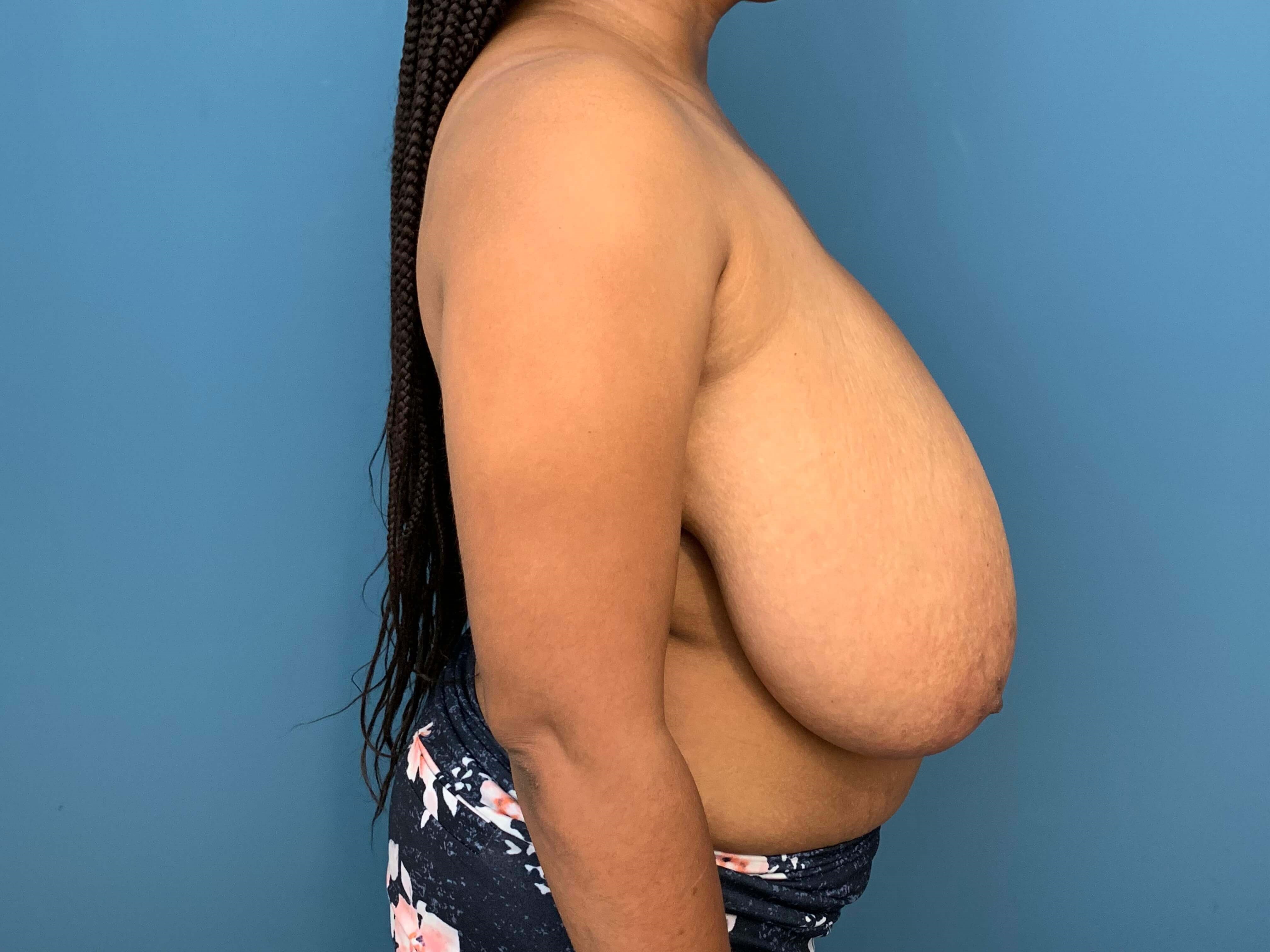 Bilateral Reduction Mammaplasty From H Cup to DD Cup — before, view 3