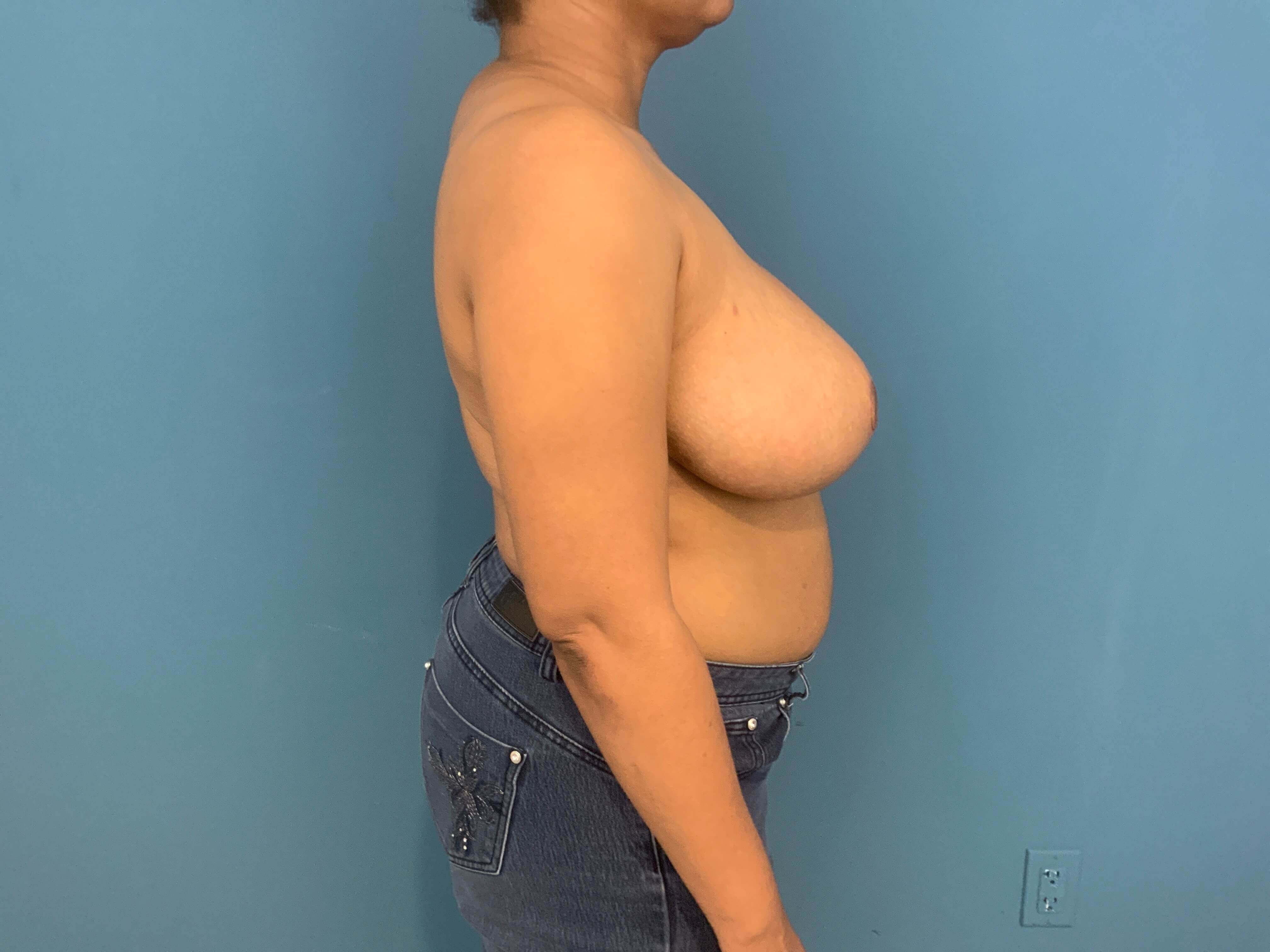Bilateral Reduction Mammaplasty From H Cup to DD Cup — after, view 3