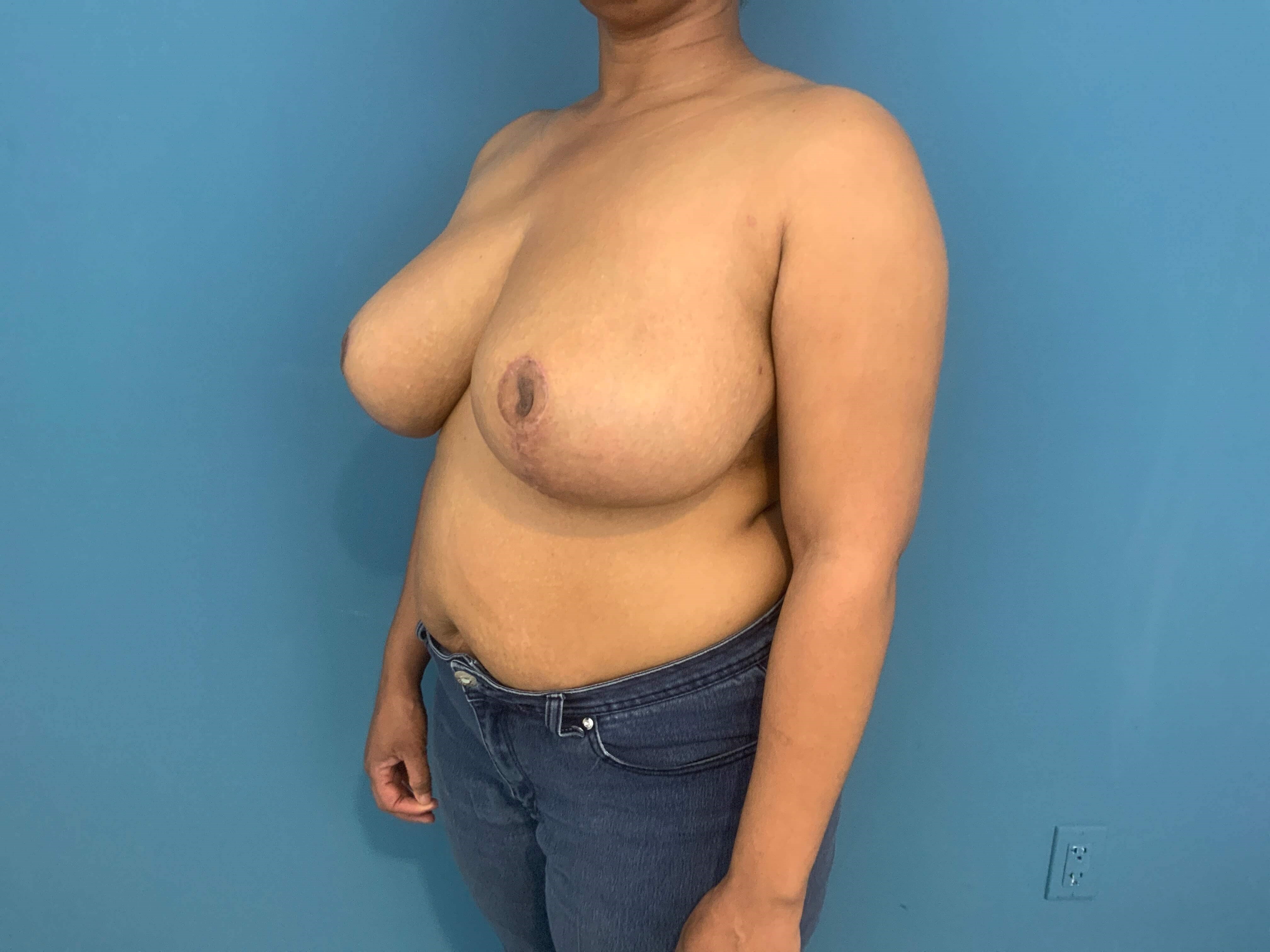 Bilateral Reduction Mammaplasty From H Cup to DD Cup — after, view 4
