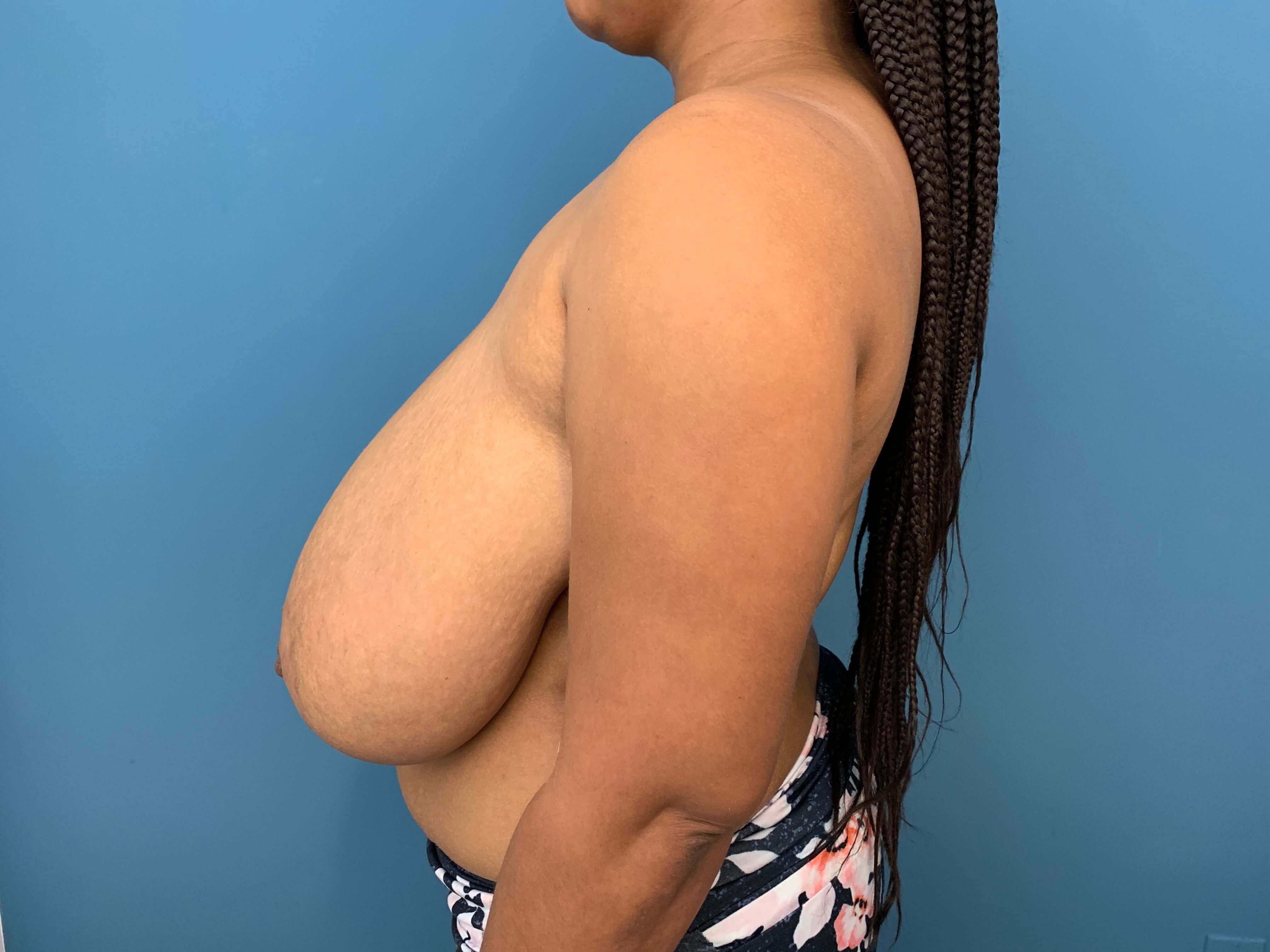 Bilateral Reduction Mammaplasty From H Cup to DD Cup — before, view 5