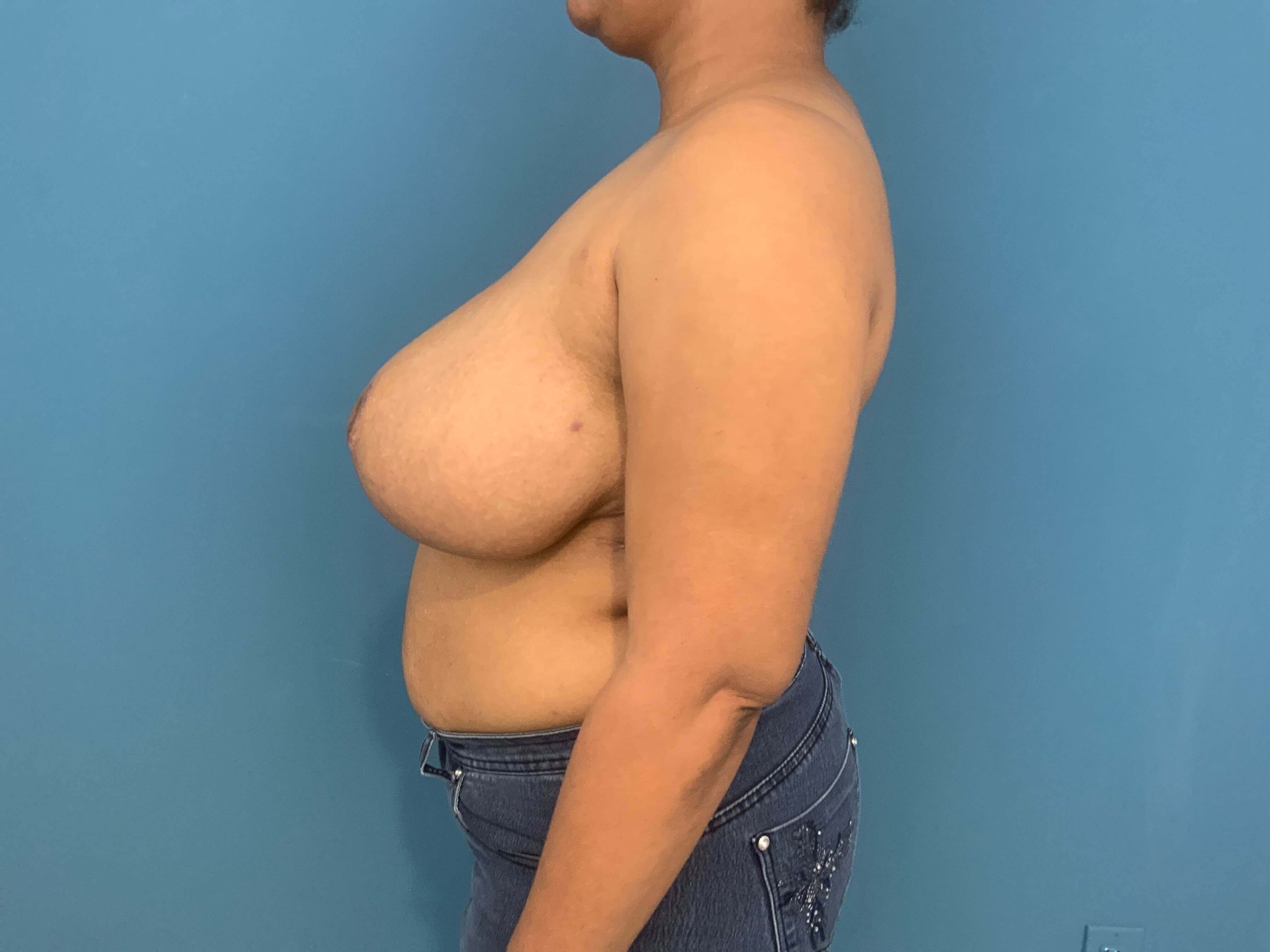 Bilateral Reduction Mammaplasty From H Cup to DD Cup — after, view 5