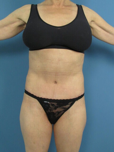 Abdominoplasty and Flank Liposuction in an Athletic Woman — before, view 2