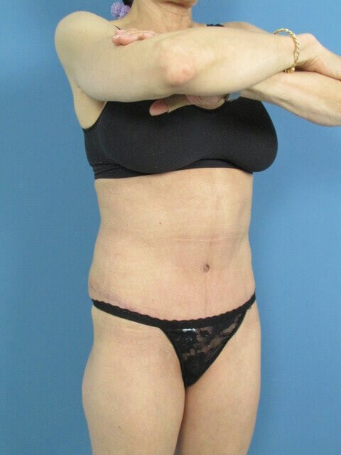 Abdominoplasty and Flank Liposuction in an Athletic Woman — before, view 4