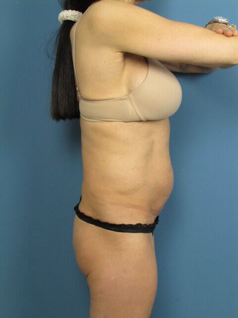 Abdominoplasty and Flank Liposuction in an Athletic Woman — before, view 5