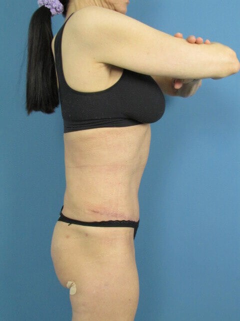 Abdominoplasty and Flank Liposuction in an Athletic Woman — before, view 6