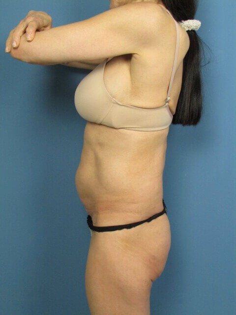 Abdominoplasty and Flank Liposuction in an Athletic Woman — after, view 3