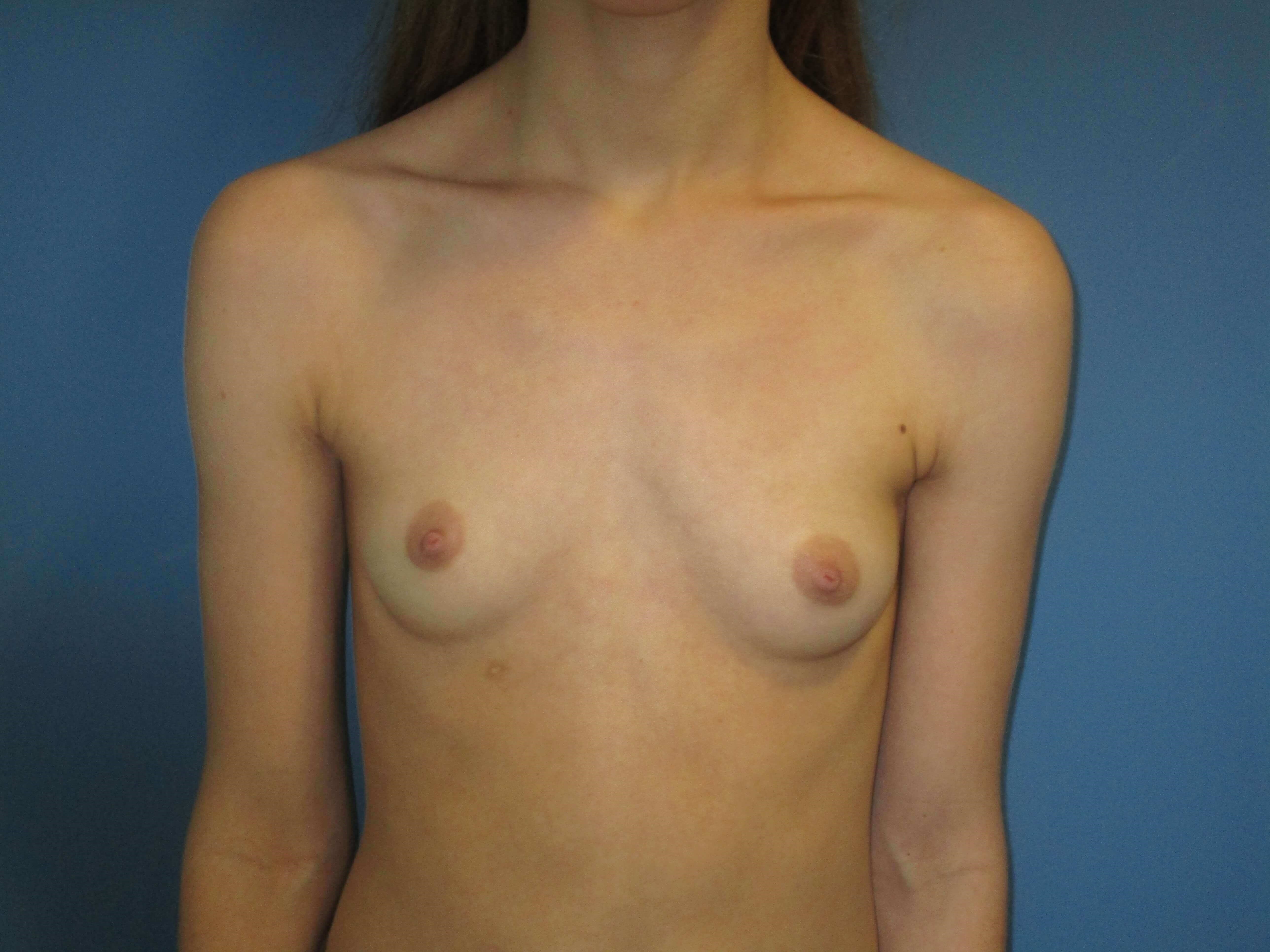 Breast Augmentation From a AA to a Small C Cup with 250 Cc High Profile Implants — before, view 1