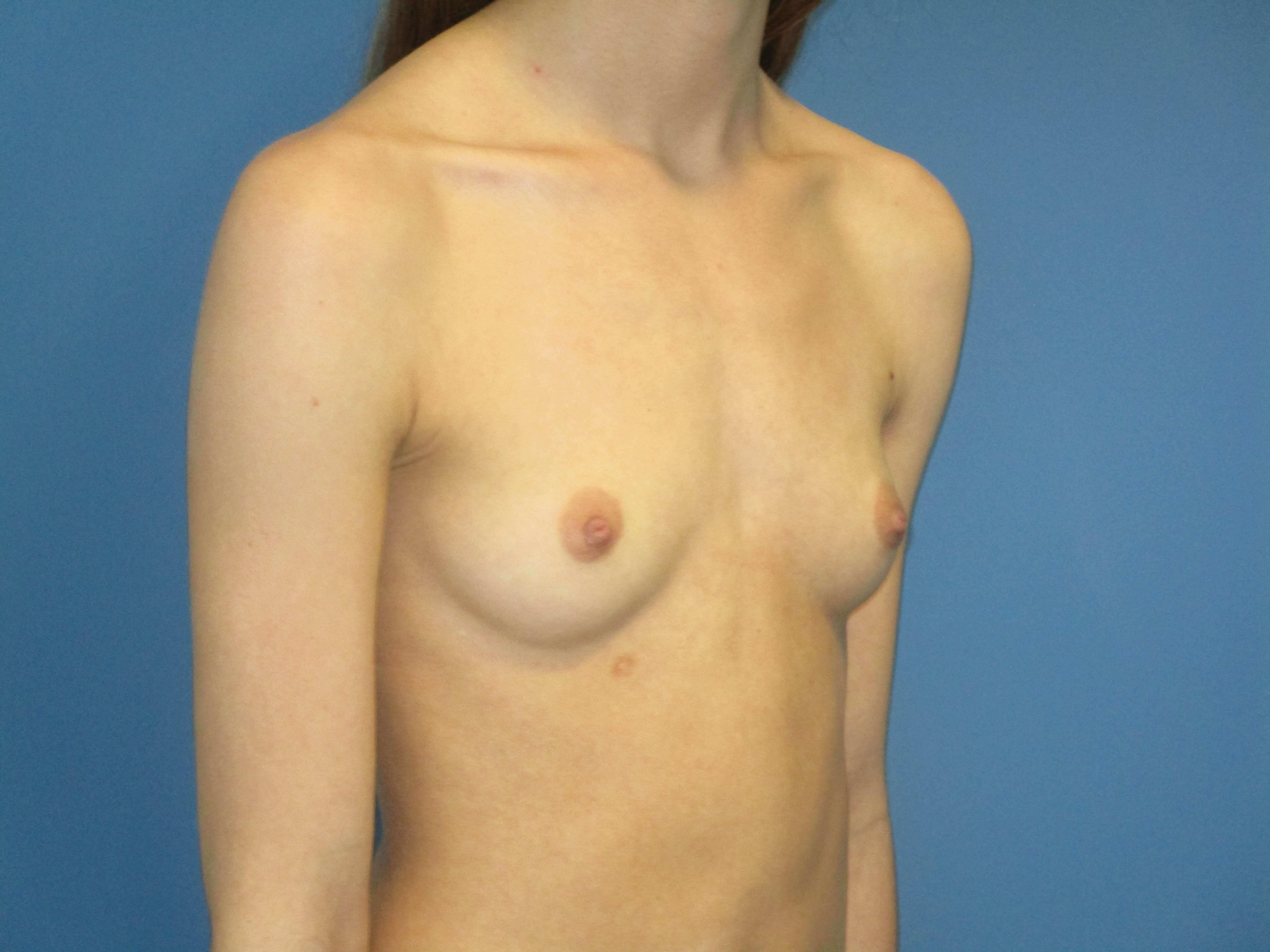 Breast Augmentation From a AA to a Small C Cup with 250 Cc High Profile Implants — before, view 2