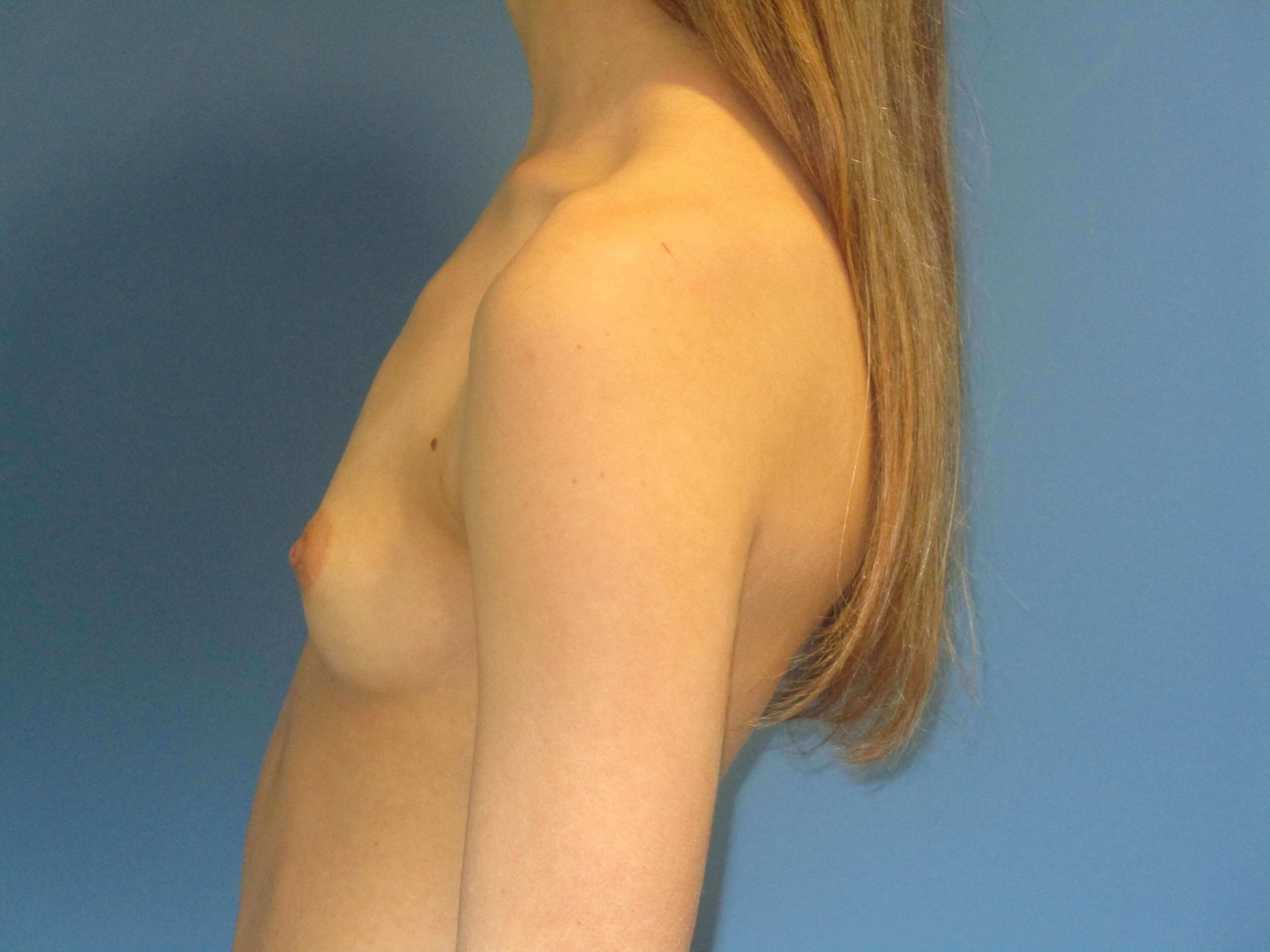 Breast Augmentation From a AA to a Small C Cup with 250 Cc High Profile Implants — before, view 5