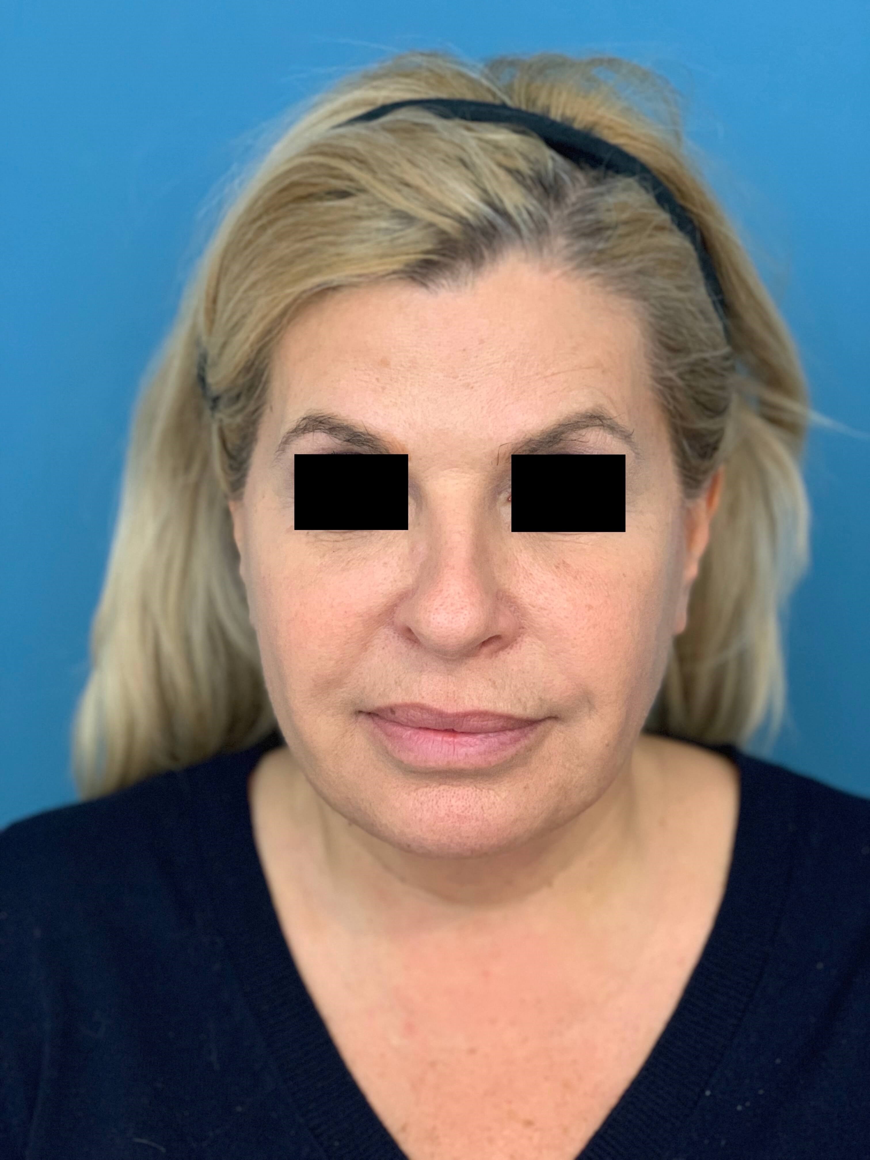 Neck Lift Procedure — before, view 2