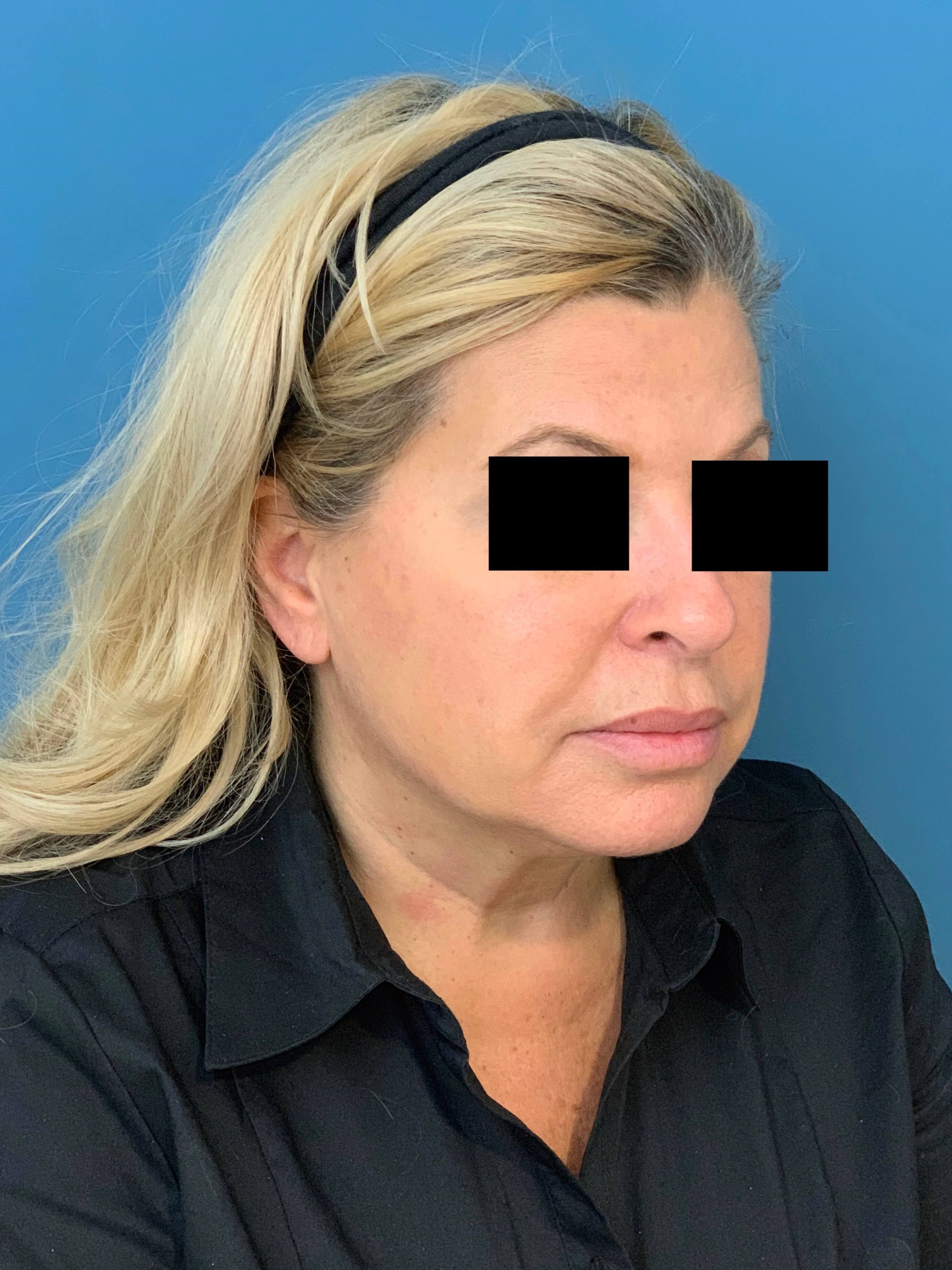 Neck Lift Procedure — before, view 3
