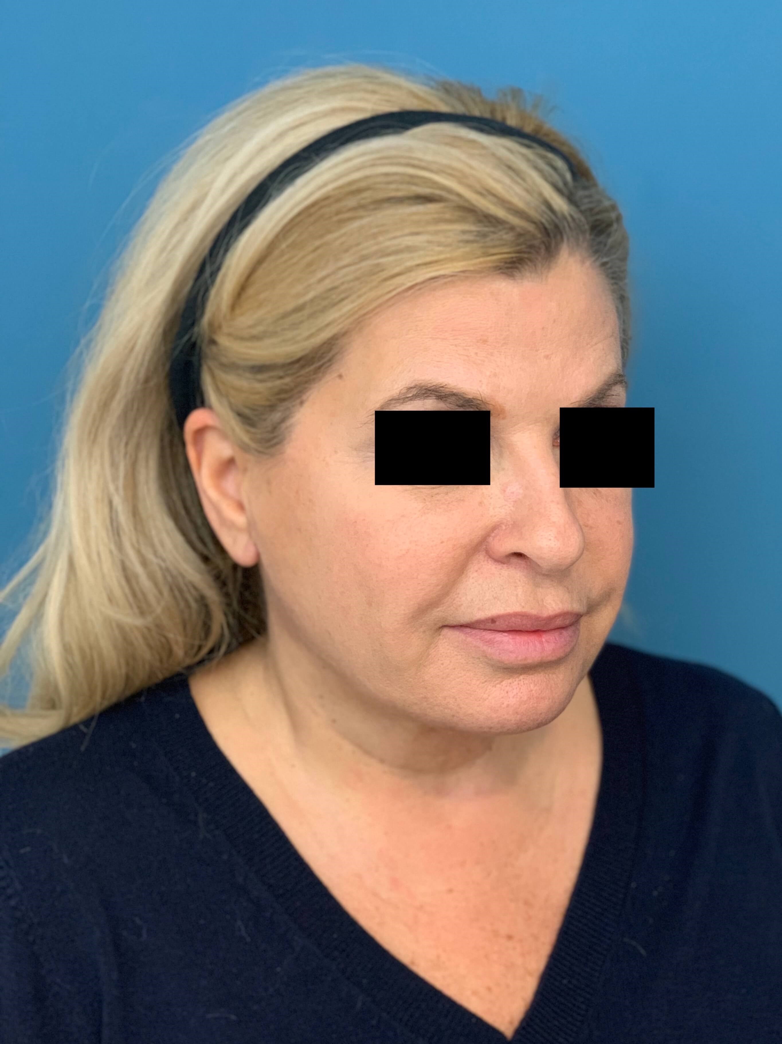 Neck Lift Procedure — before, view 4