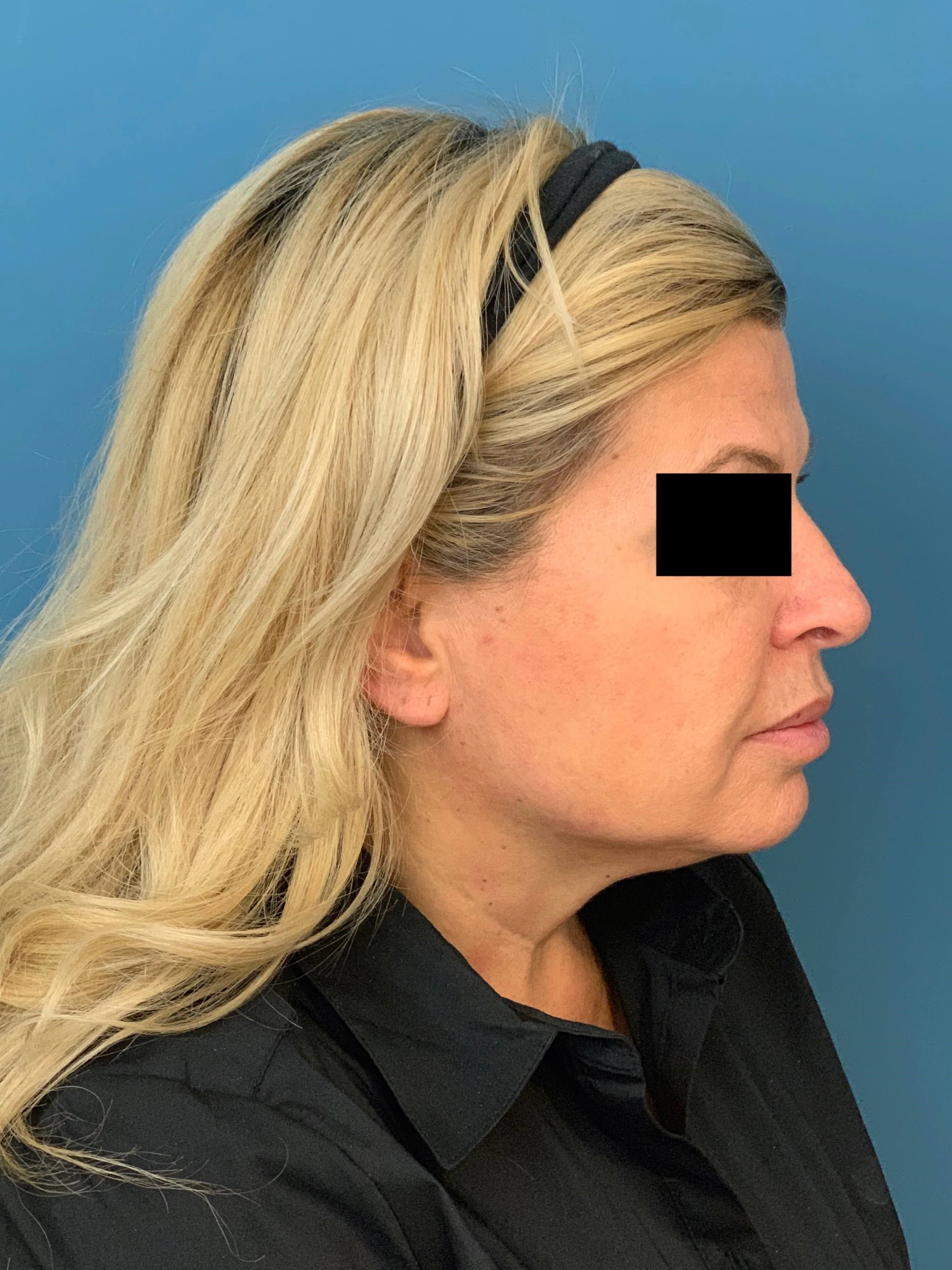 Neck Lift Procedure — before, view 5