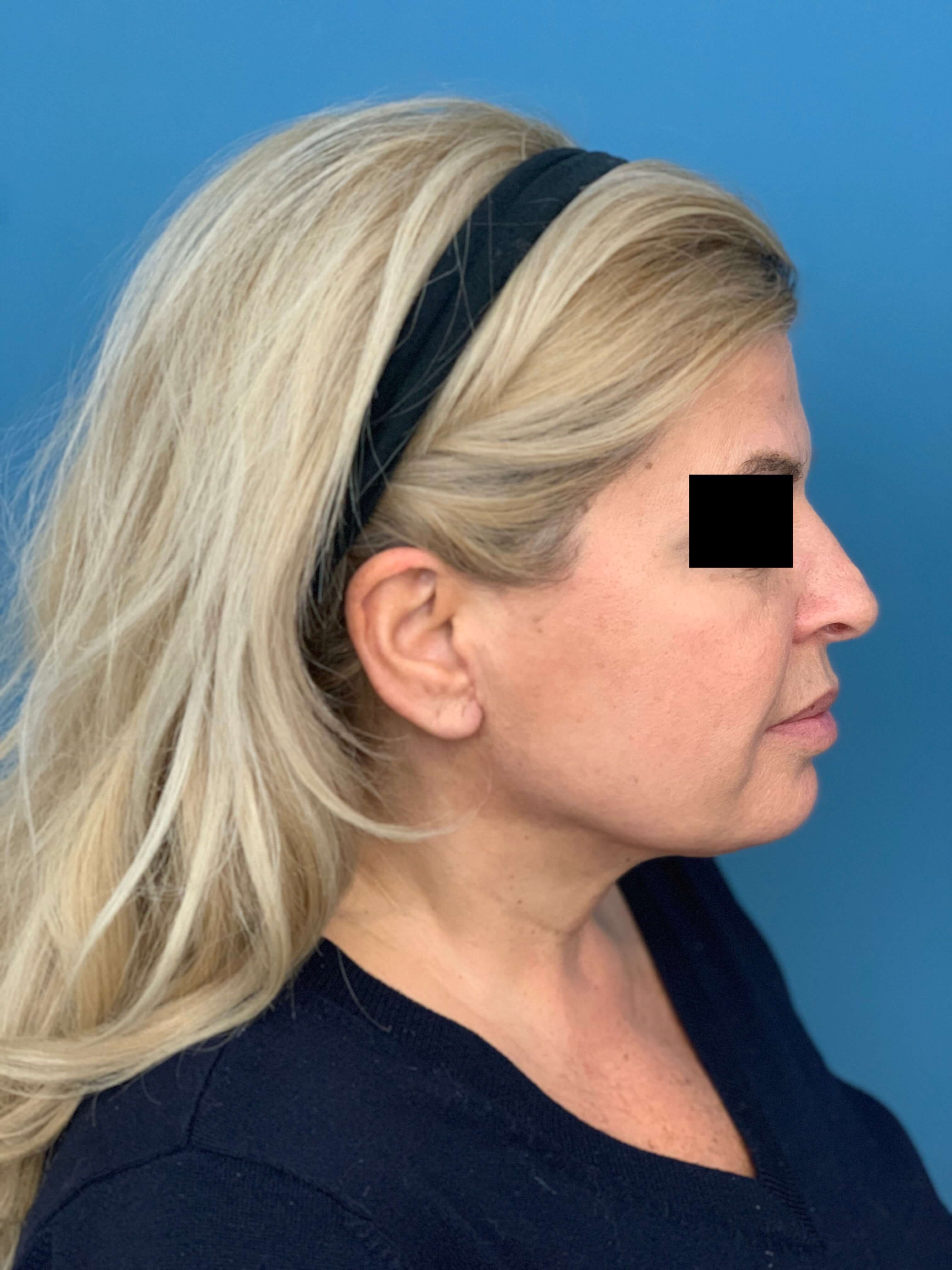 Neck Lift Procedure