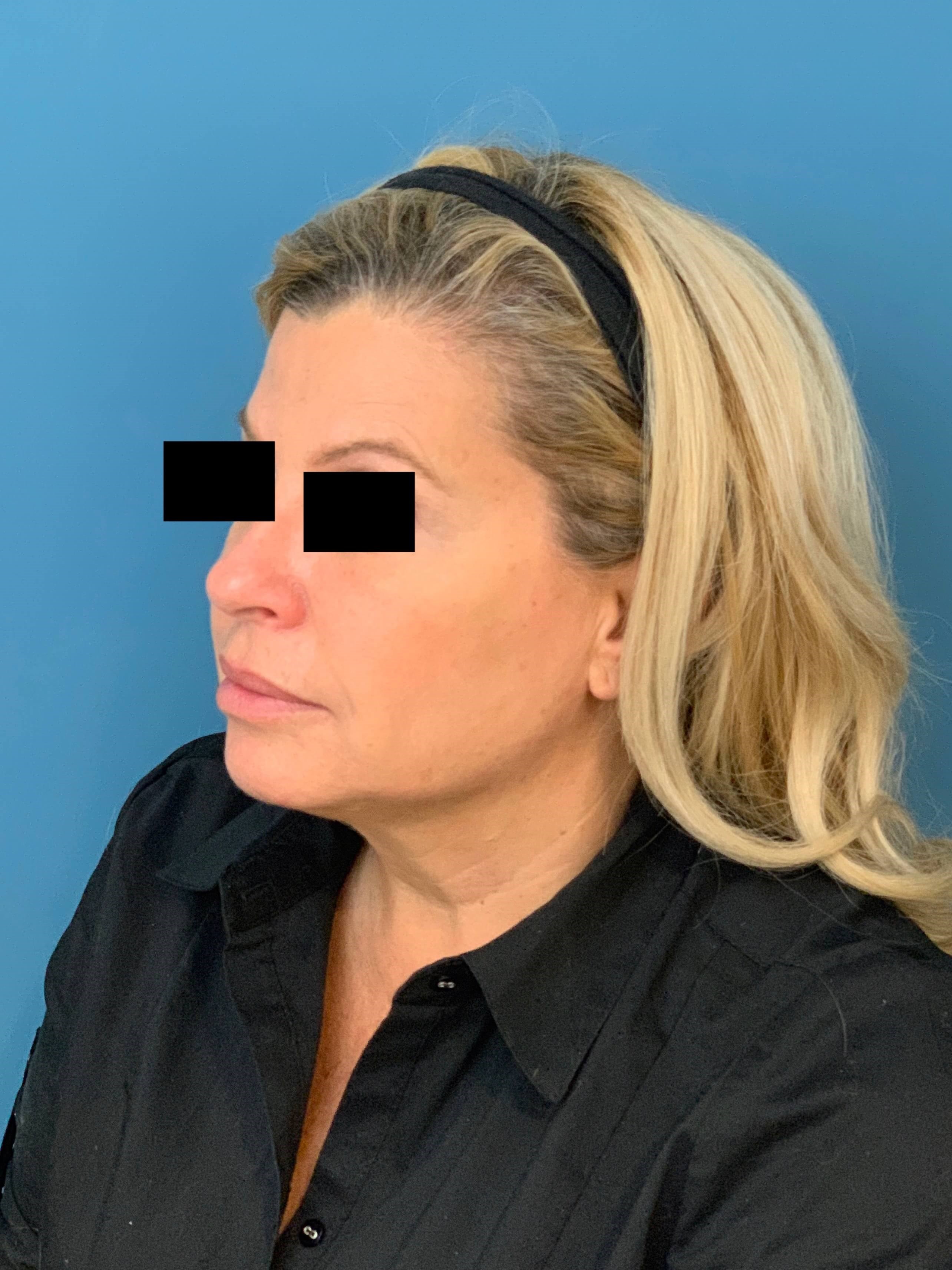 Neck Lift Procedure — after, view 2