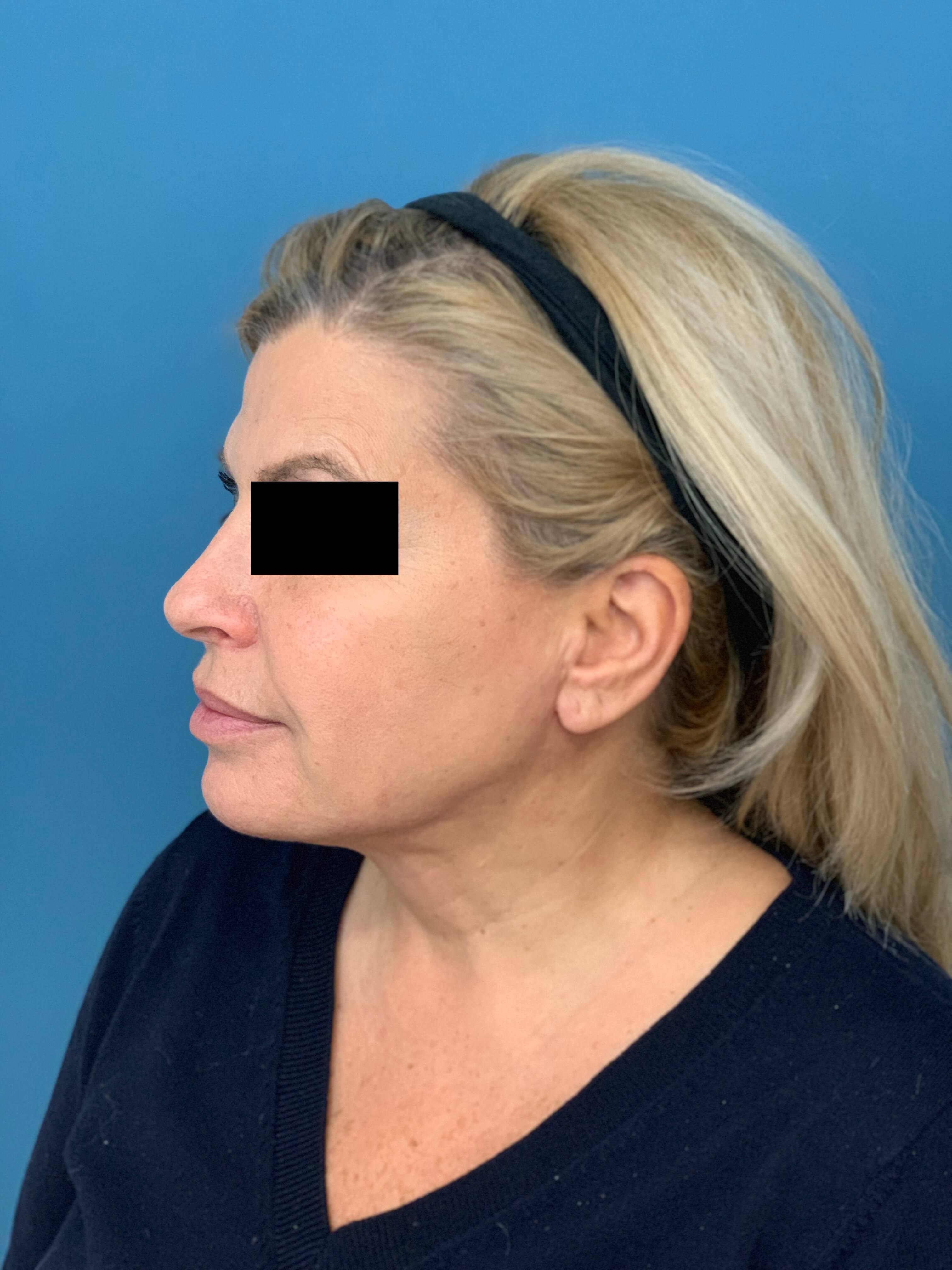 Neck Lift Procedure — after, view 3
