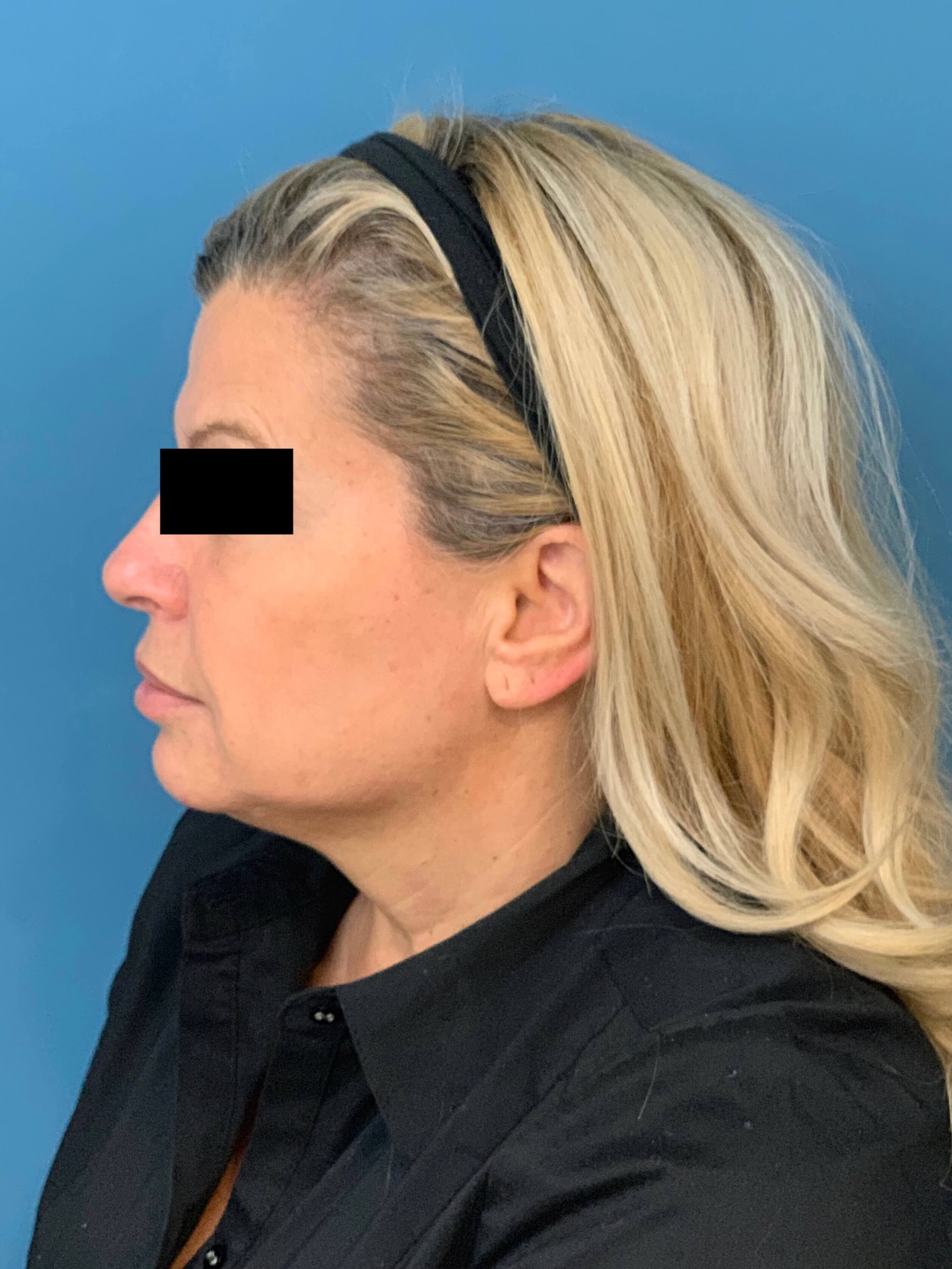 Neck Lift Procedure — after, view 4