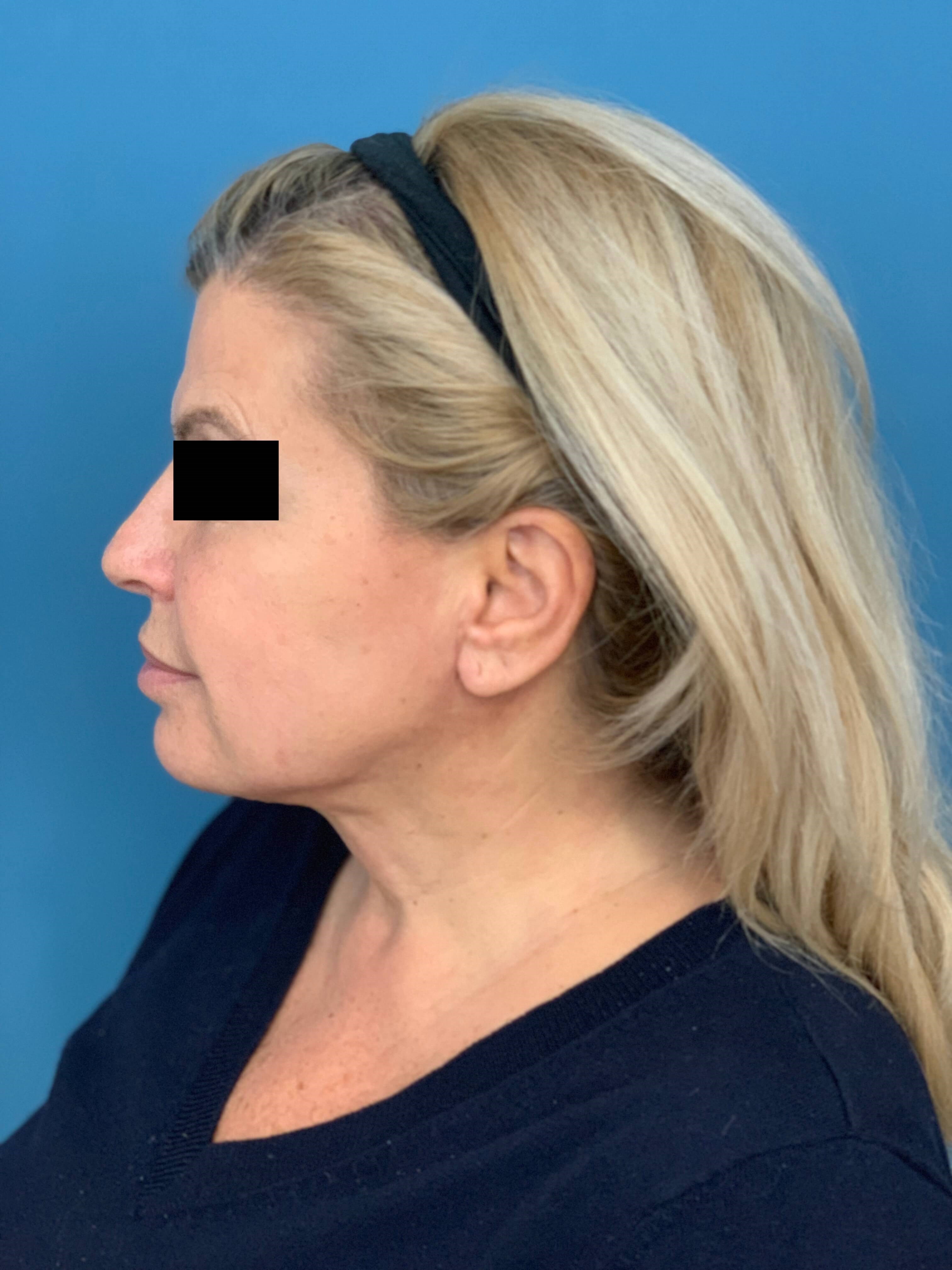 Neck Lift Procedure — after, view 5