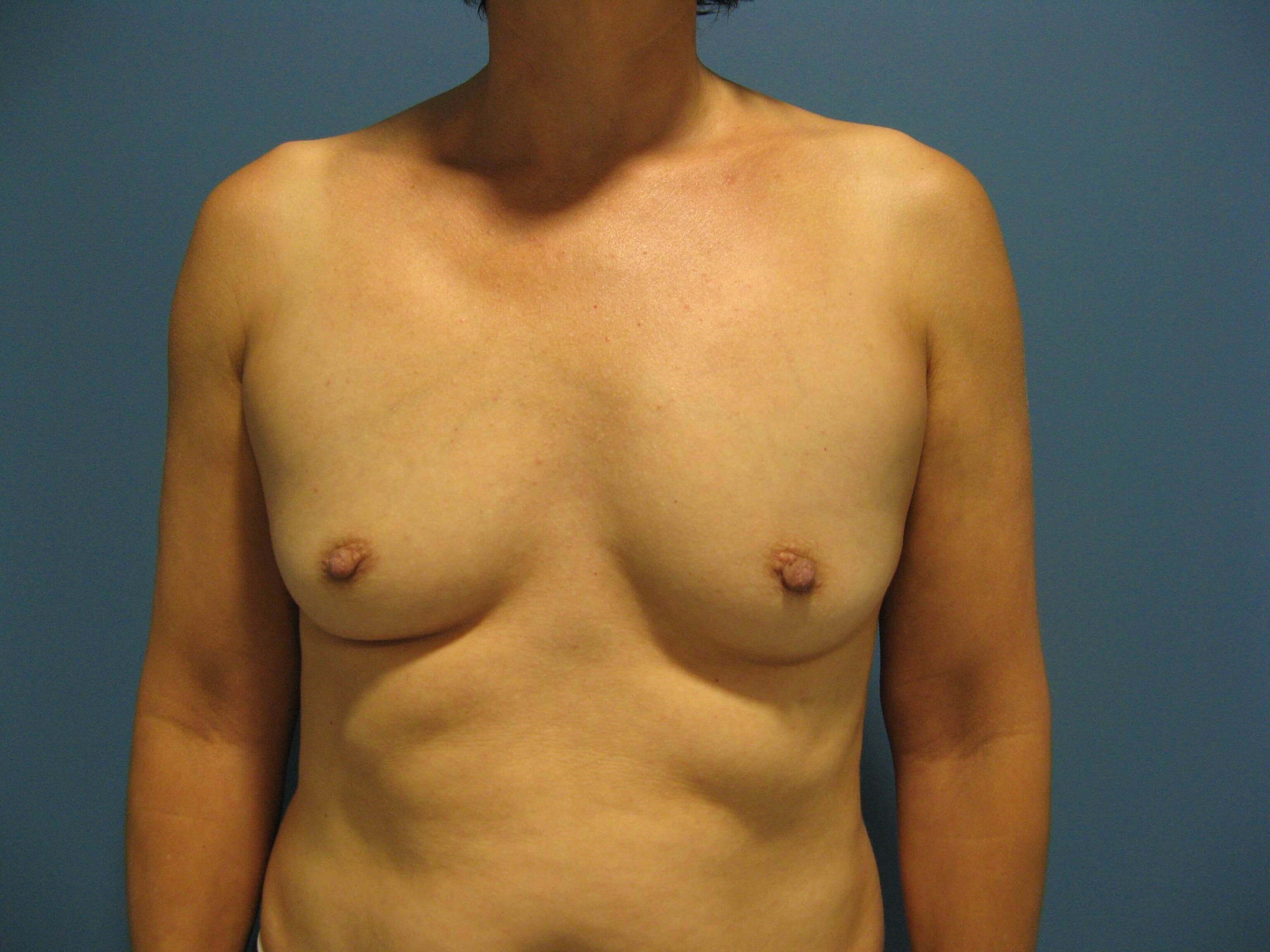 Bilateral Dual Plane Breast Augmentation with Silicone Implants 400 Cc — before, view 1