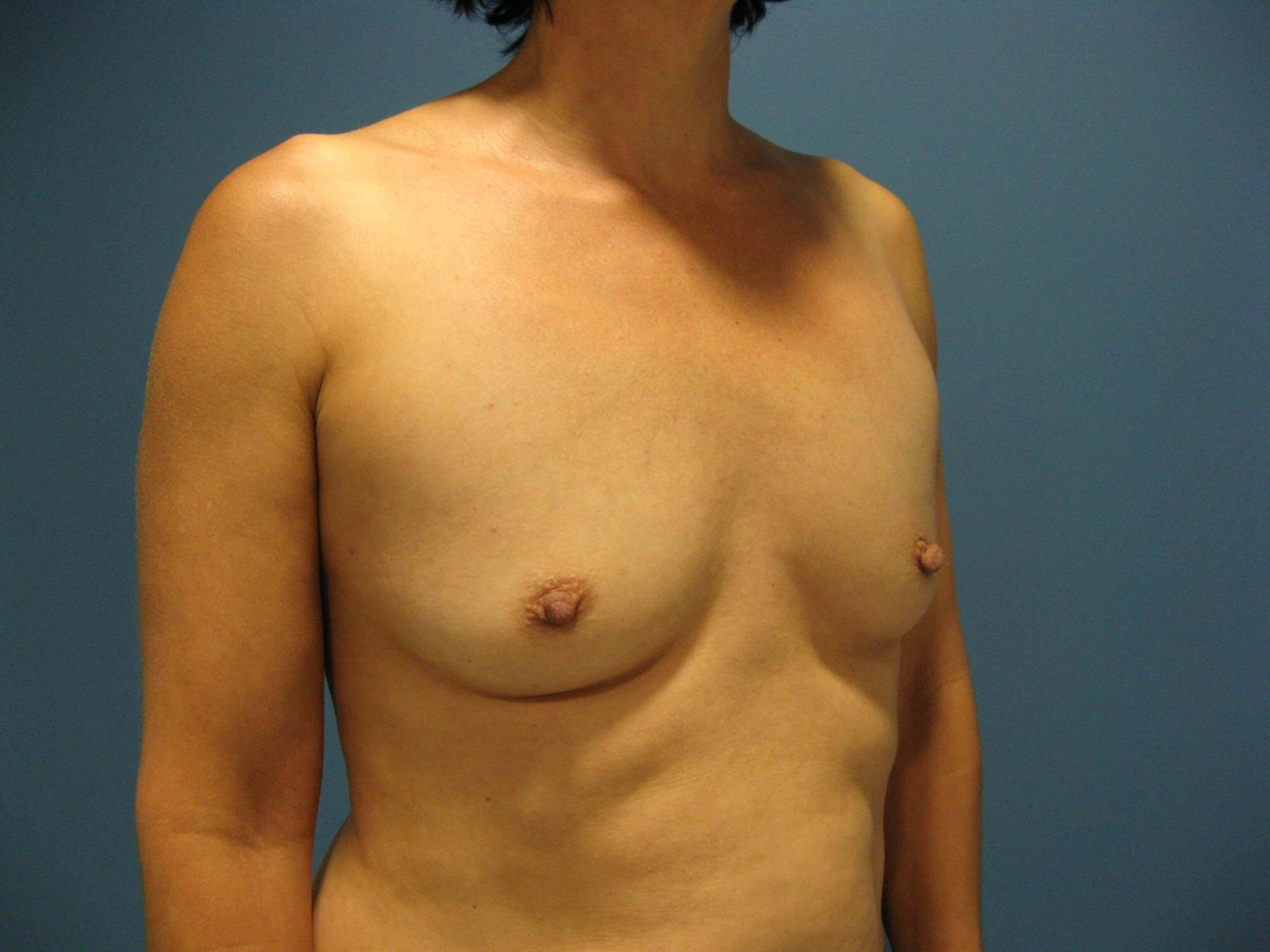 Bilateral Dual Plane Breast Augmentation with Silicone Implants 400 Cc — before, view 2