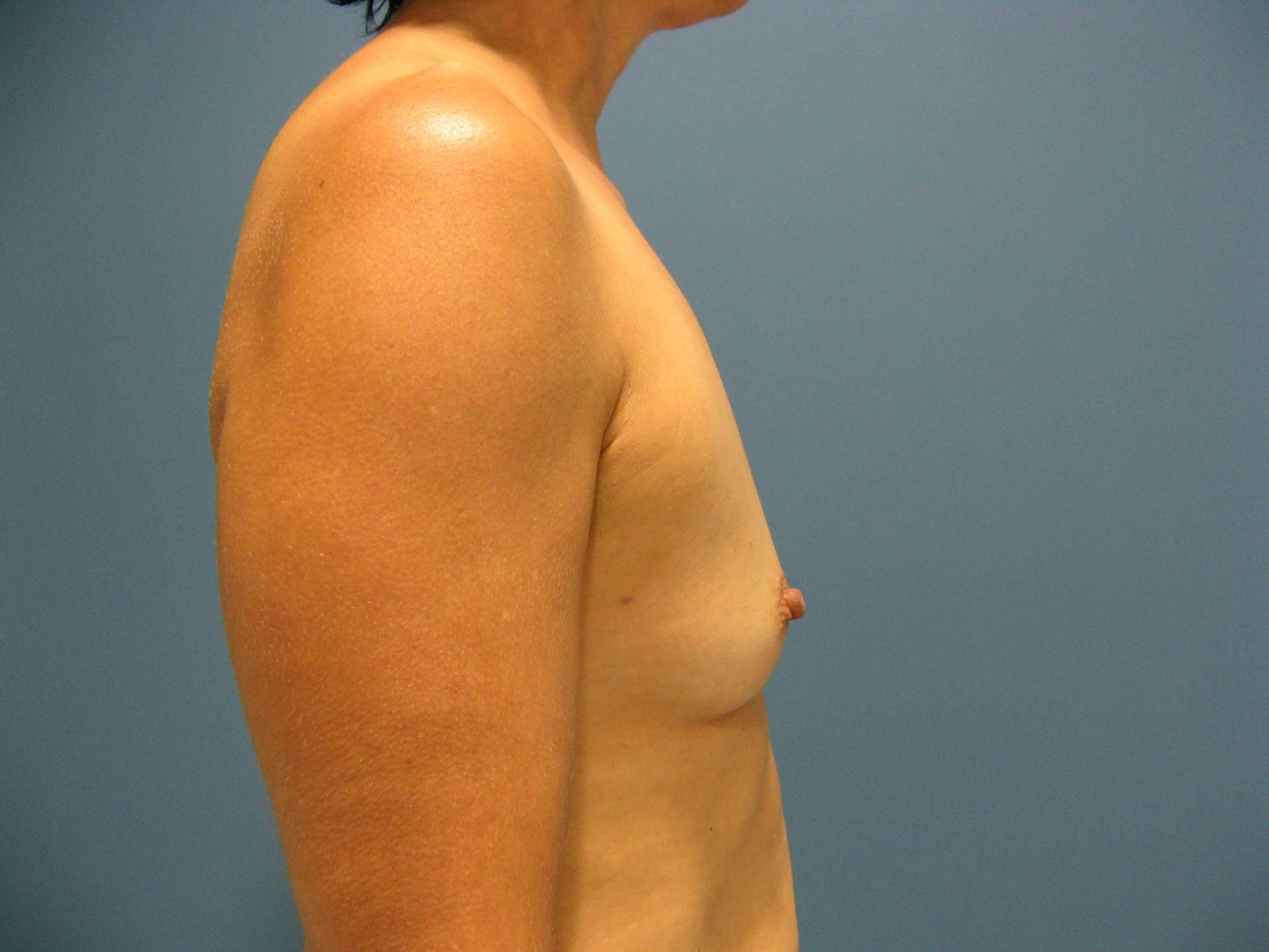 Bilateral Dual Plane Breast Augmentation with Silicone Implants 400 Cc — before, view 3