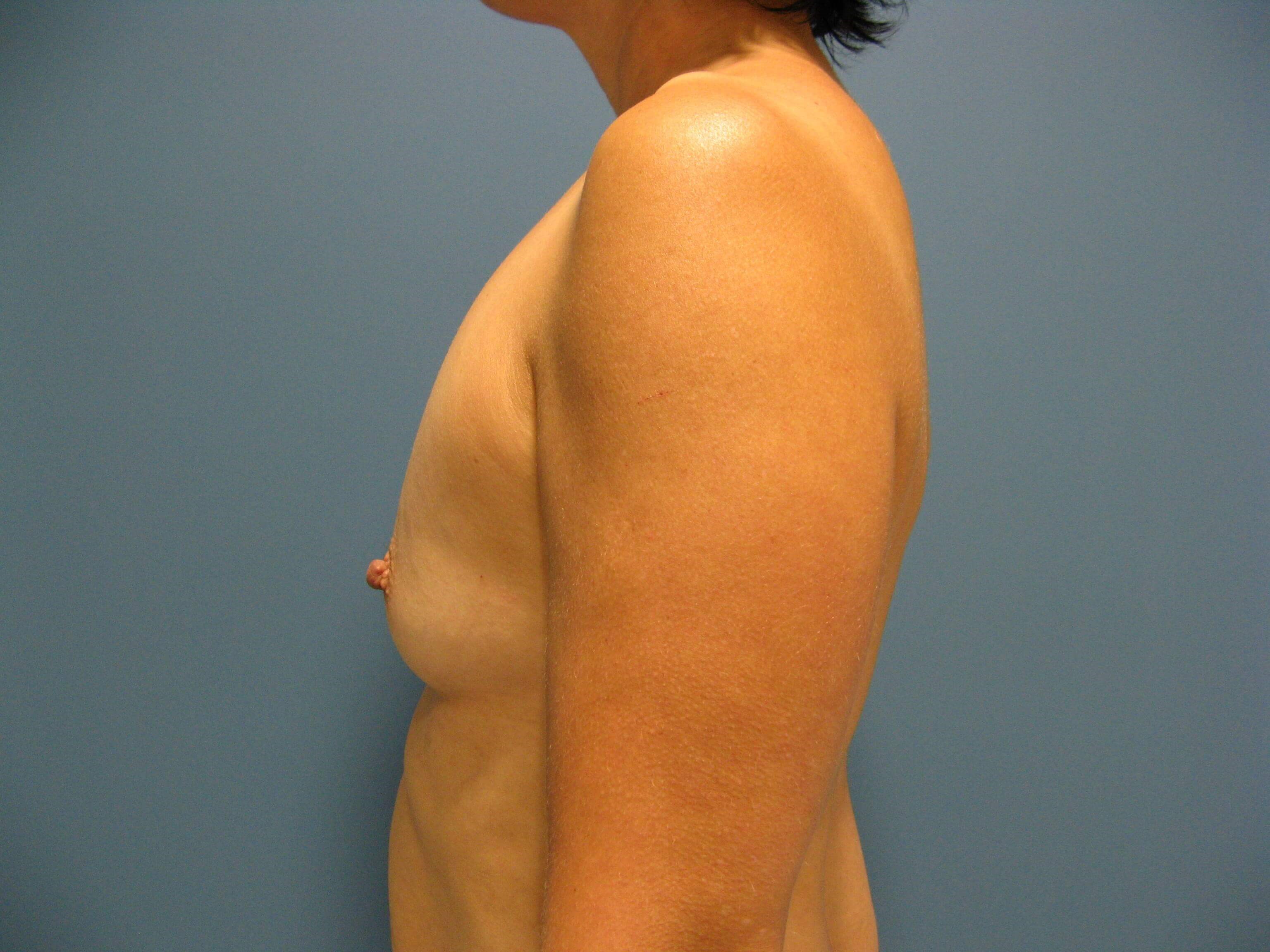 Bilateral Dual Plane Breast Augmentation with Silicone Implants 400 Cc — before, view 5