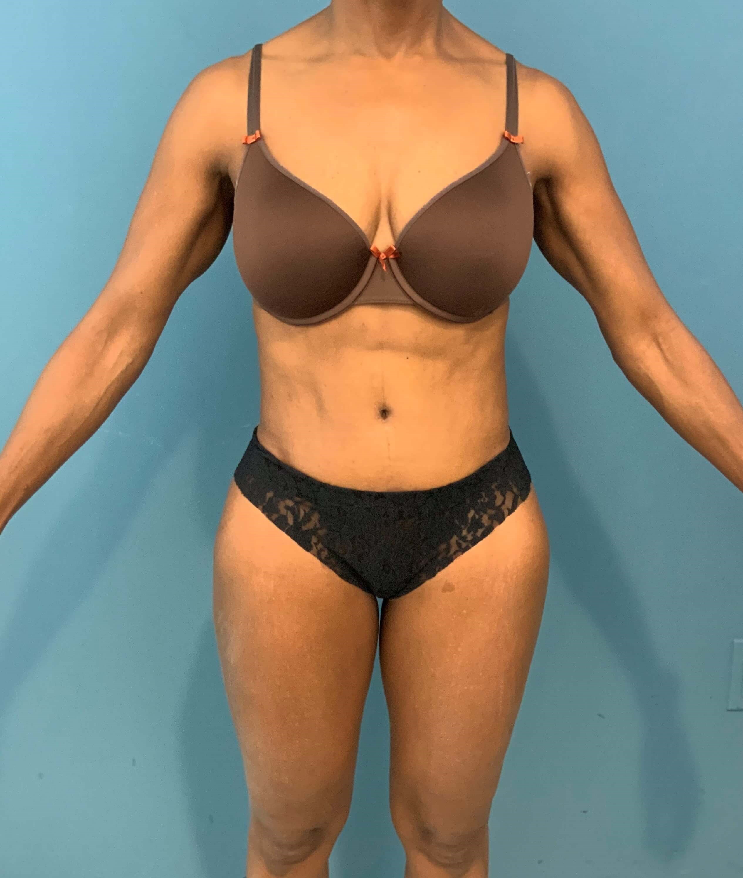 Abdominoplasty