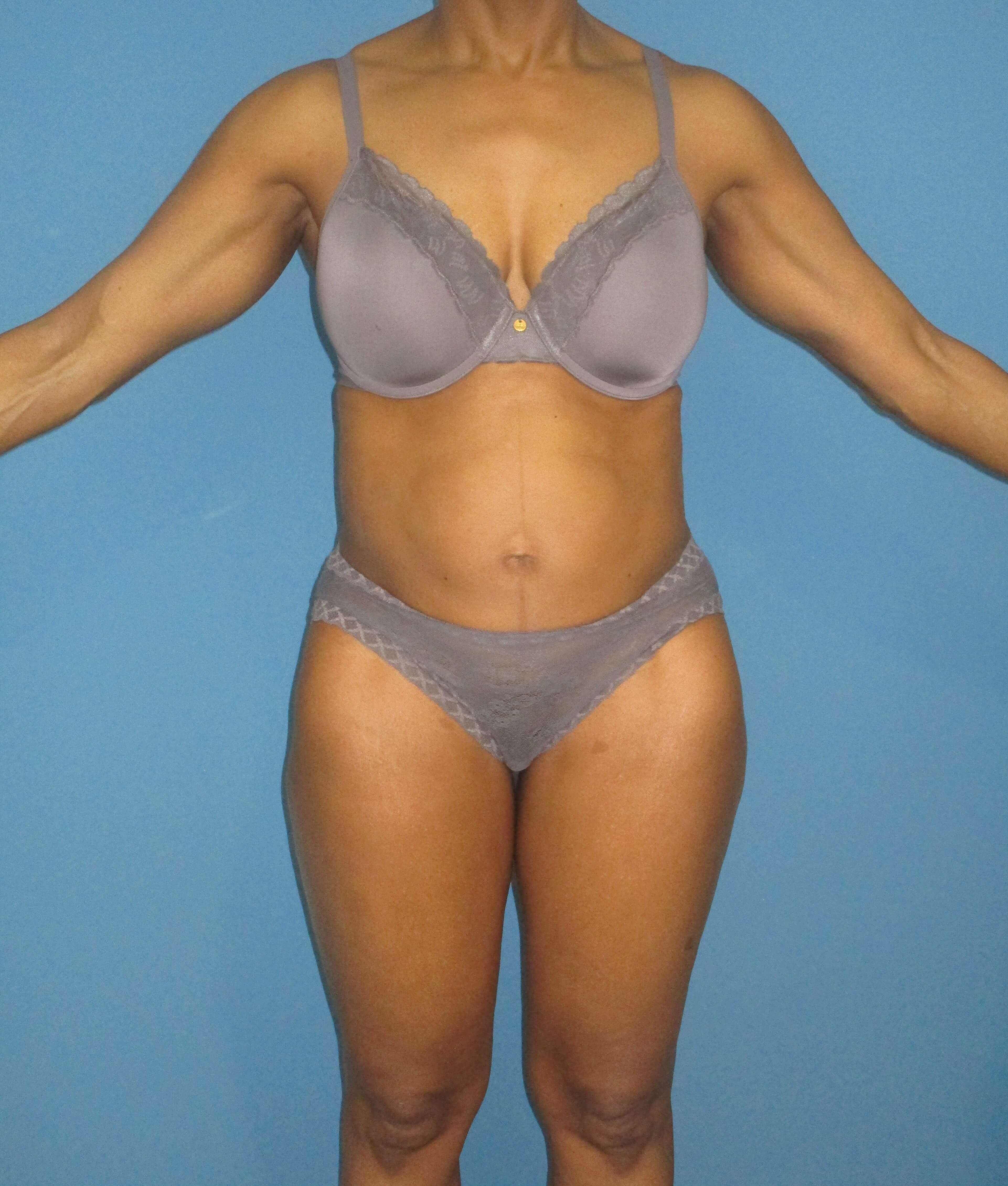Abdominoplasty — before, view 1