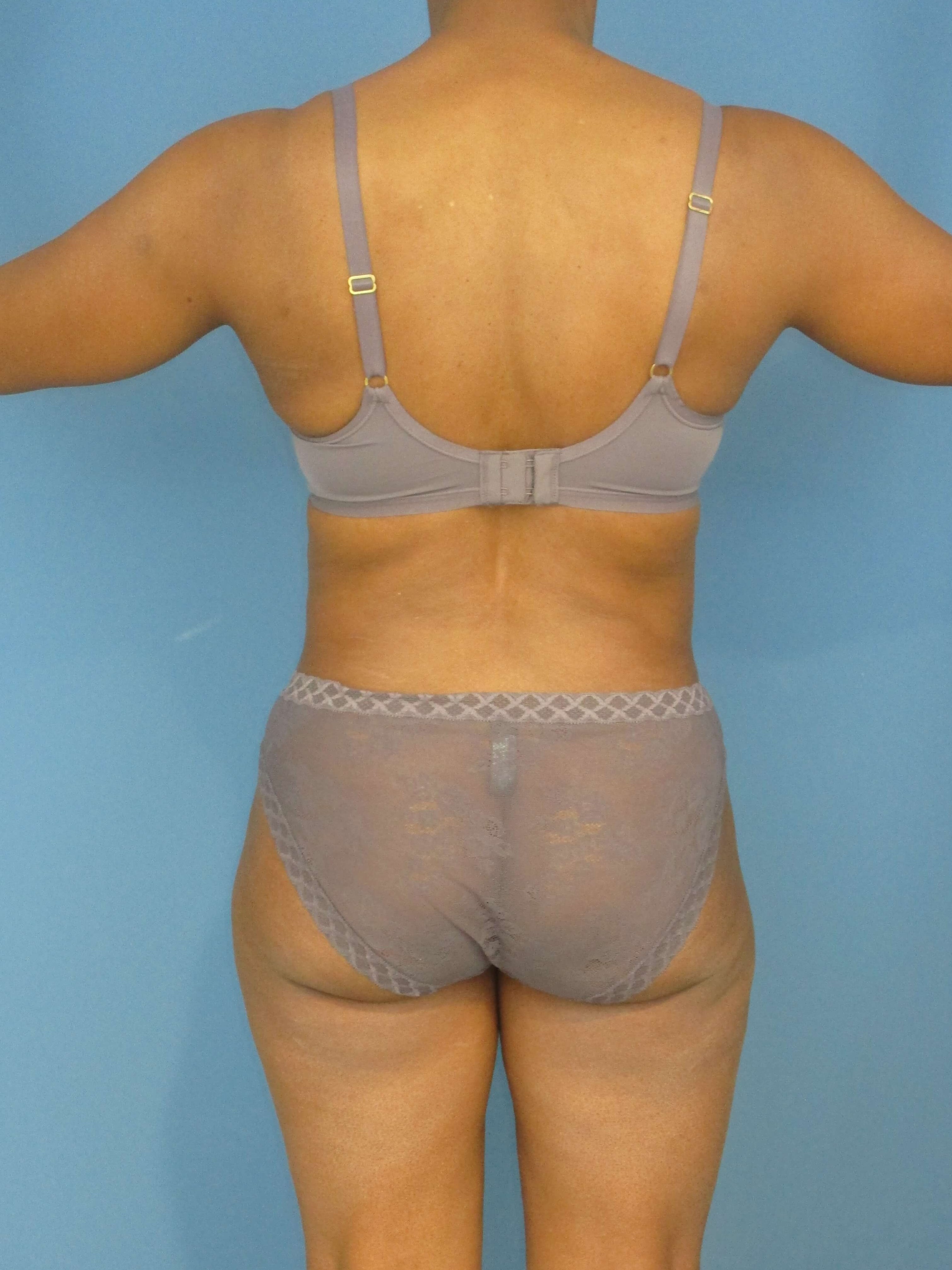 Abdominoplasty — before, view 2