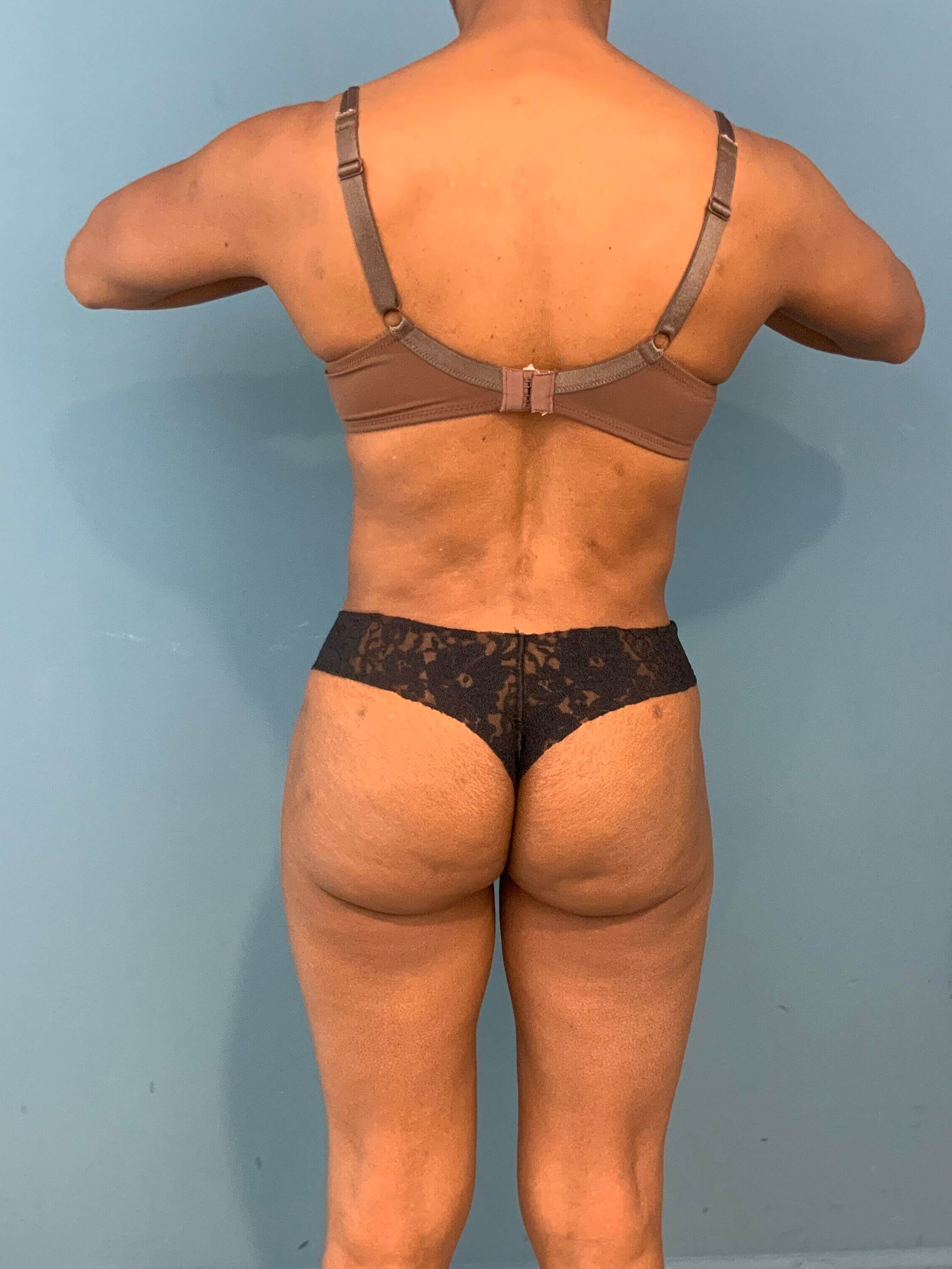 Abdominoplasty — after, view 2