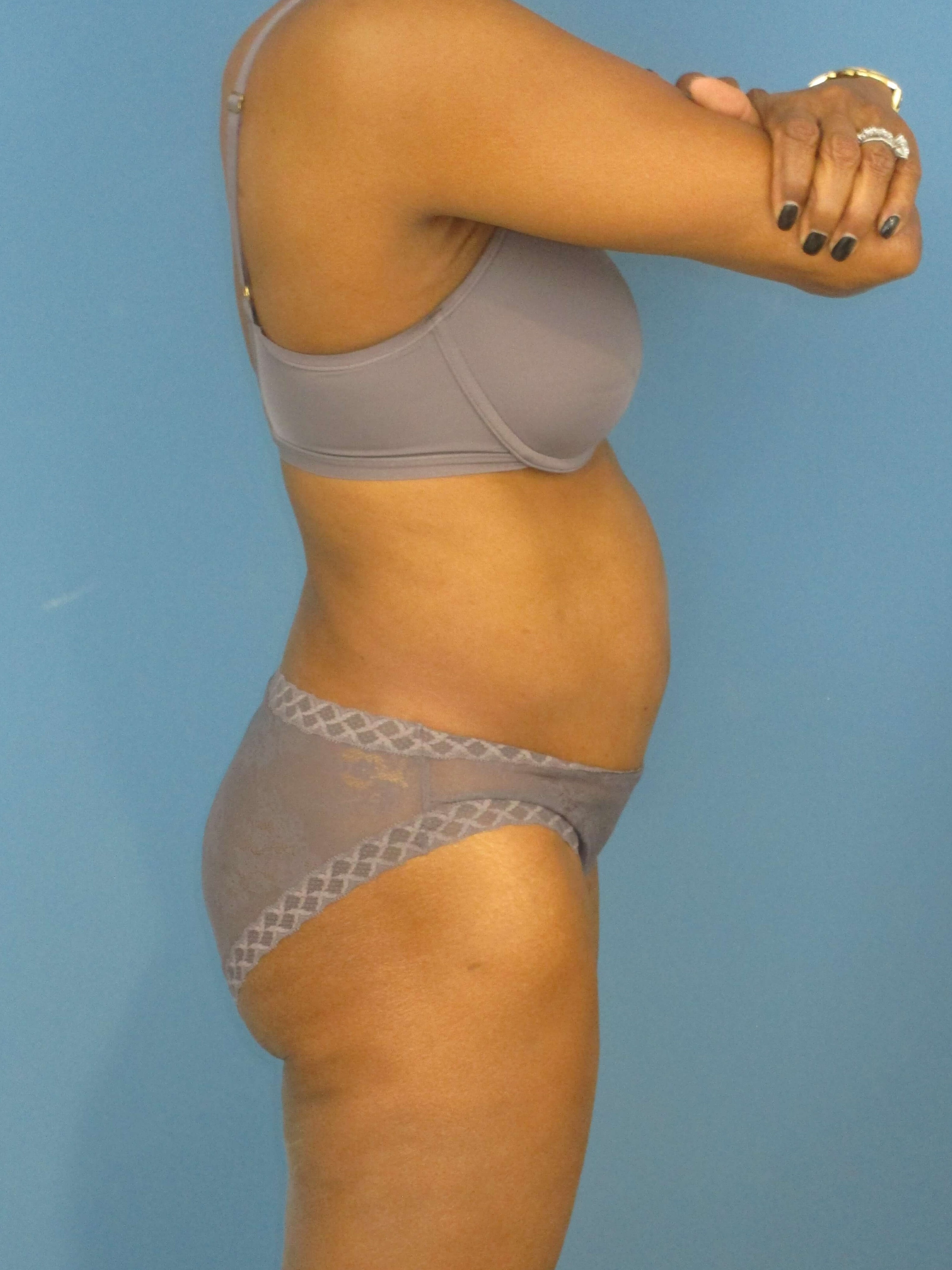 Abdominoplasty — before, view 3