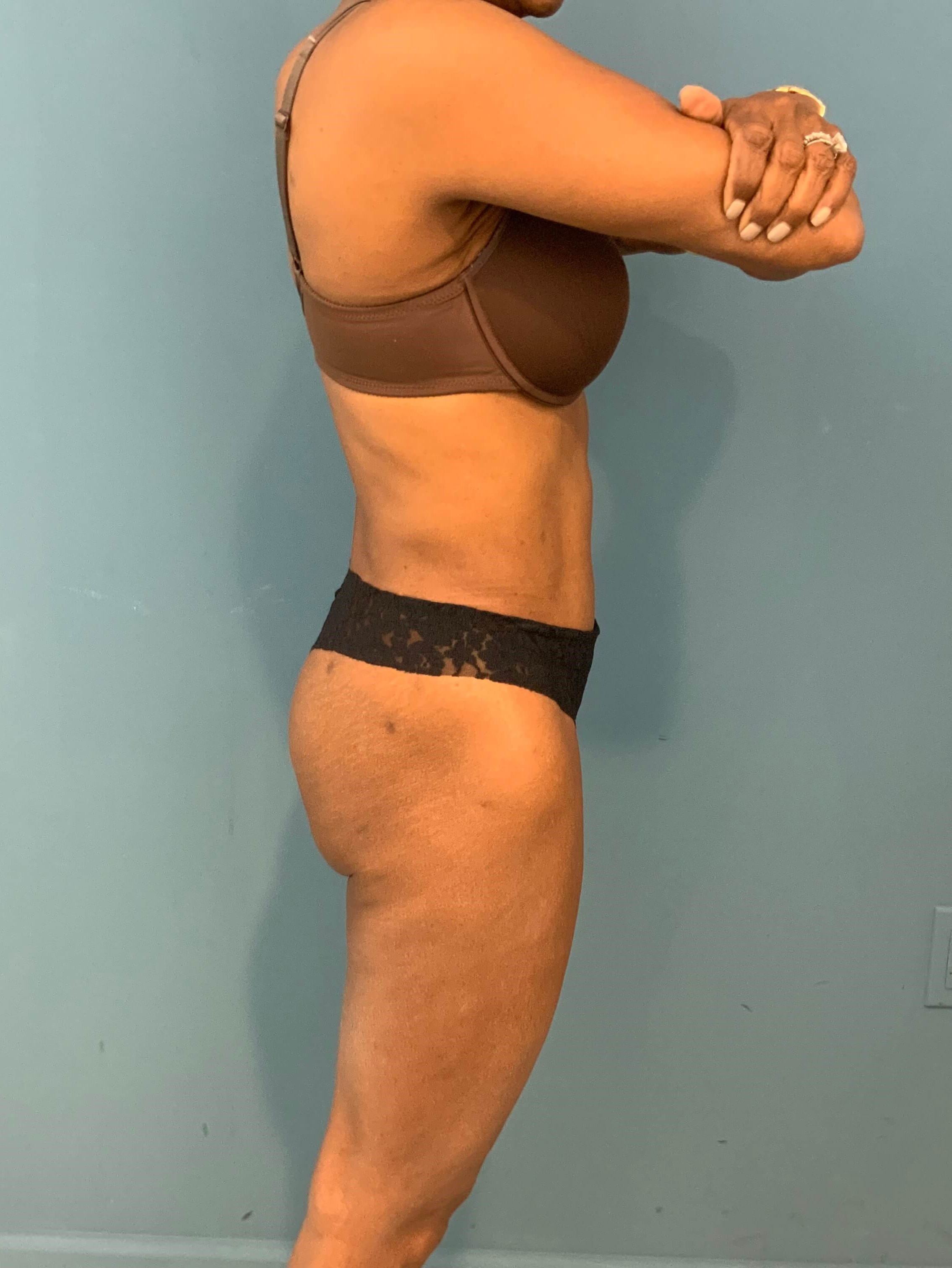 Abdominoplasty — after, view 3