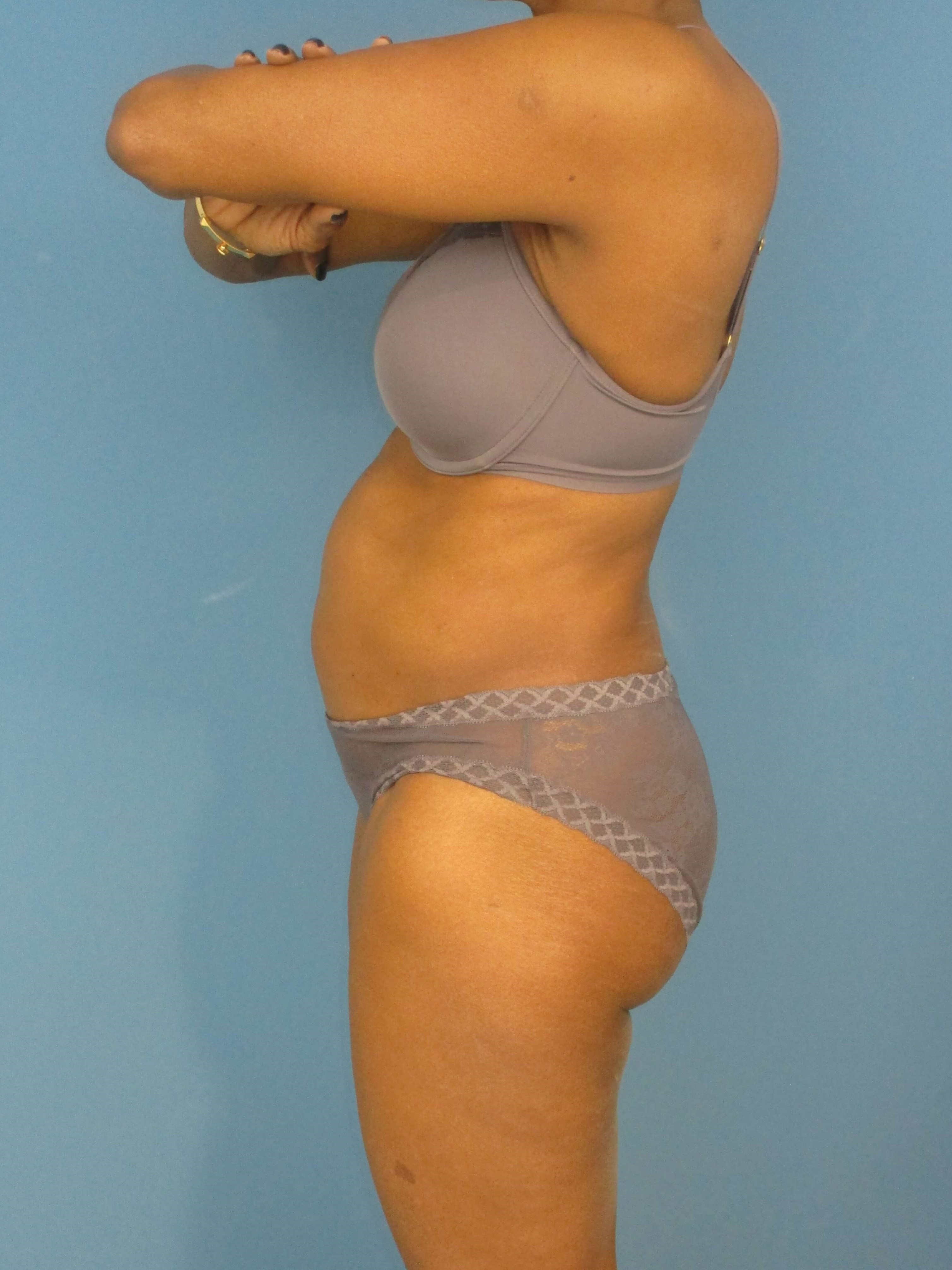 Abdominoplasty — before, view 4