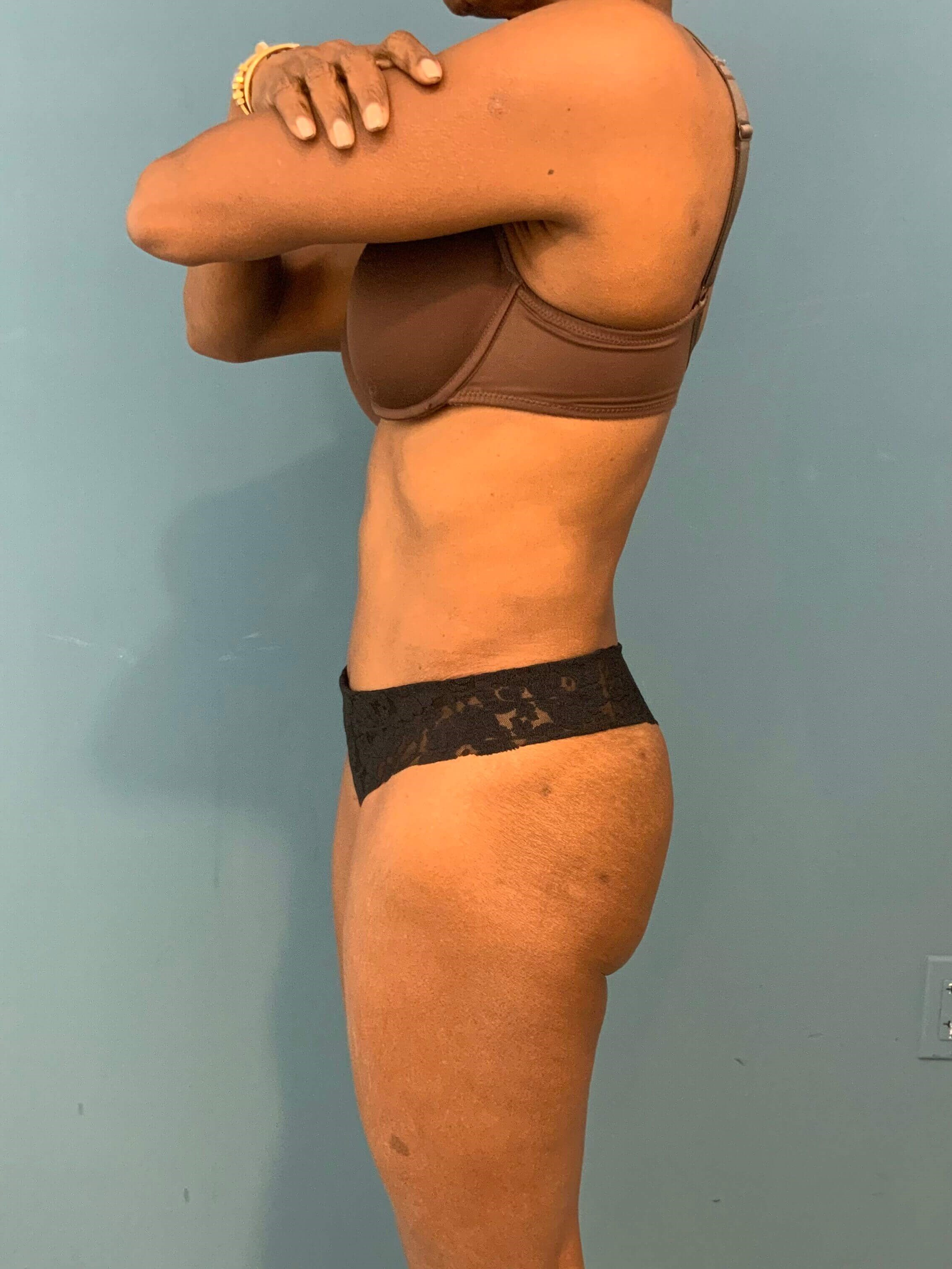 Abdominoplasty — after, view 4
