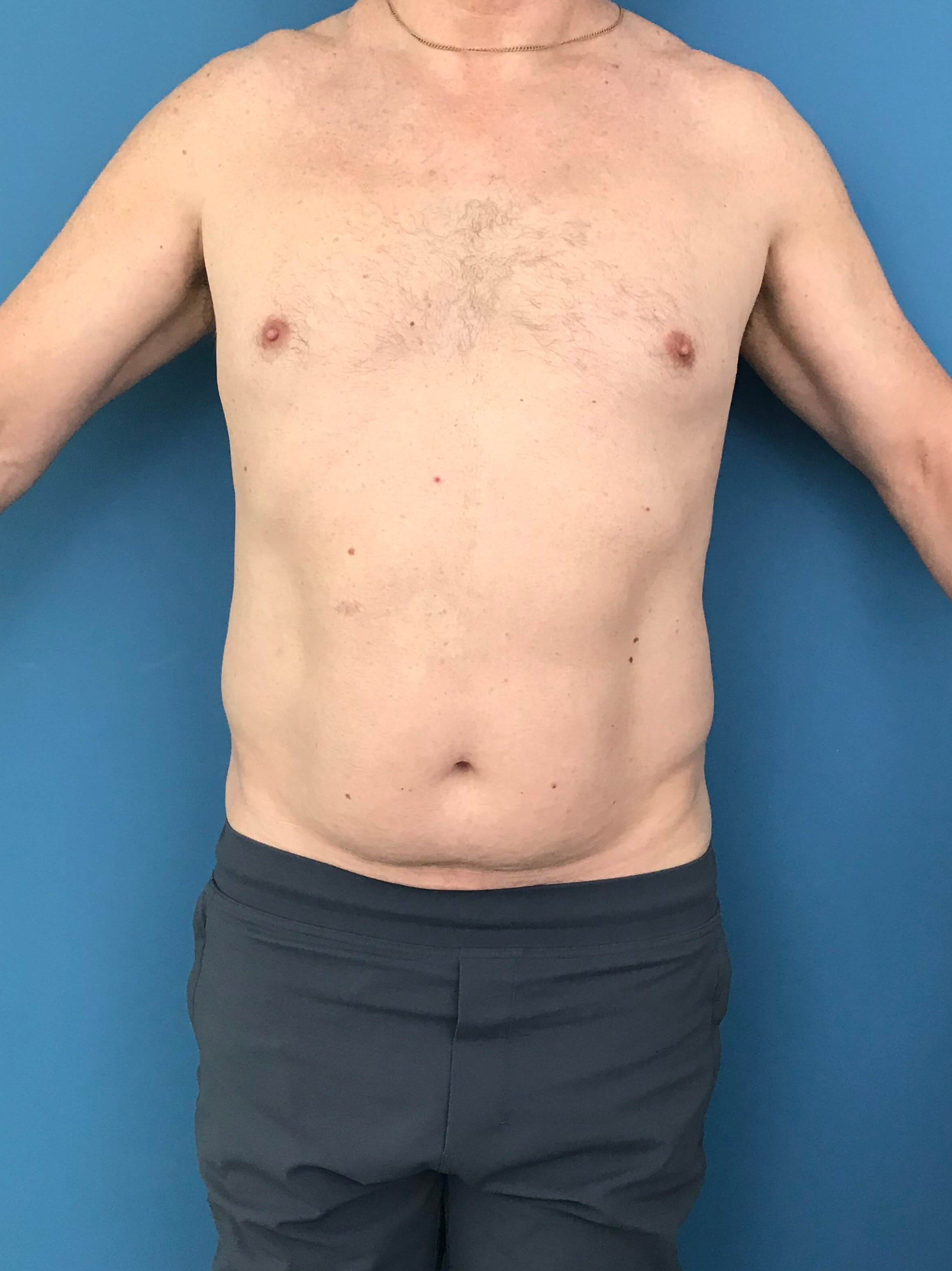 Liposuction of a Male Abdomen and Flanks with VASER — before, view 1